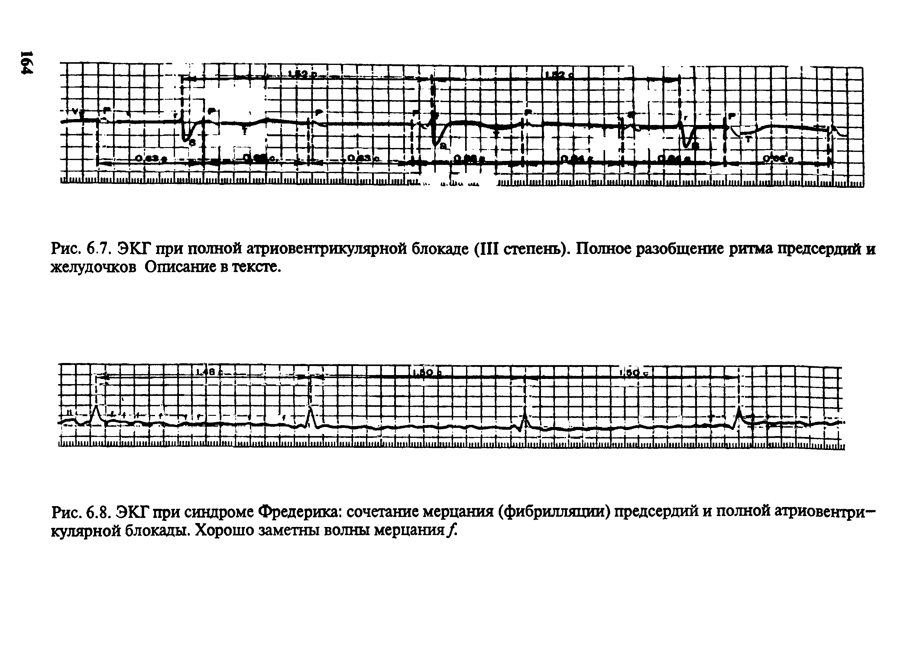 Рис. 6.8. ЭКГ при синдроме Фредерика сочетание мерцания (фибрилляции) предсердий и полной атриовентрикулярной блокады. Хорошо заметны волны мерцания/...