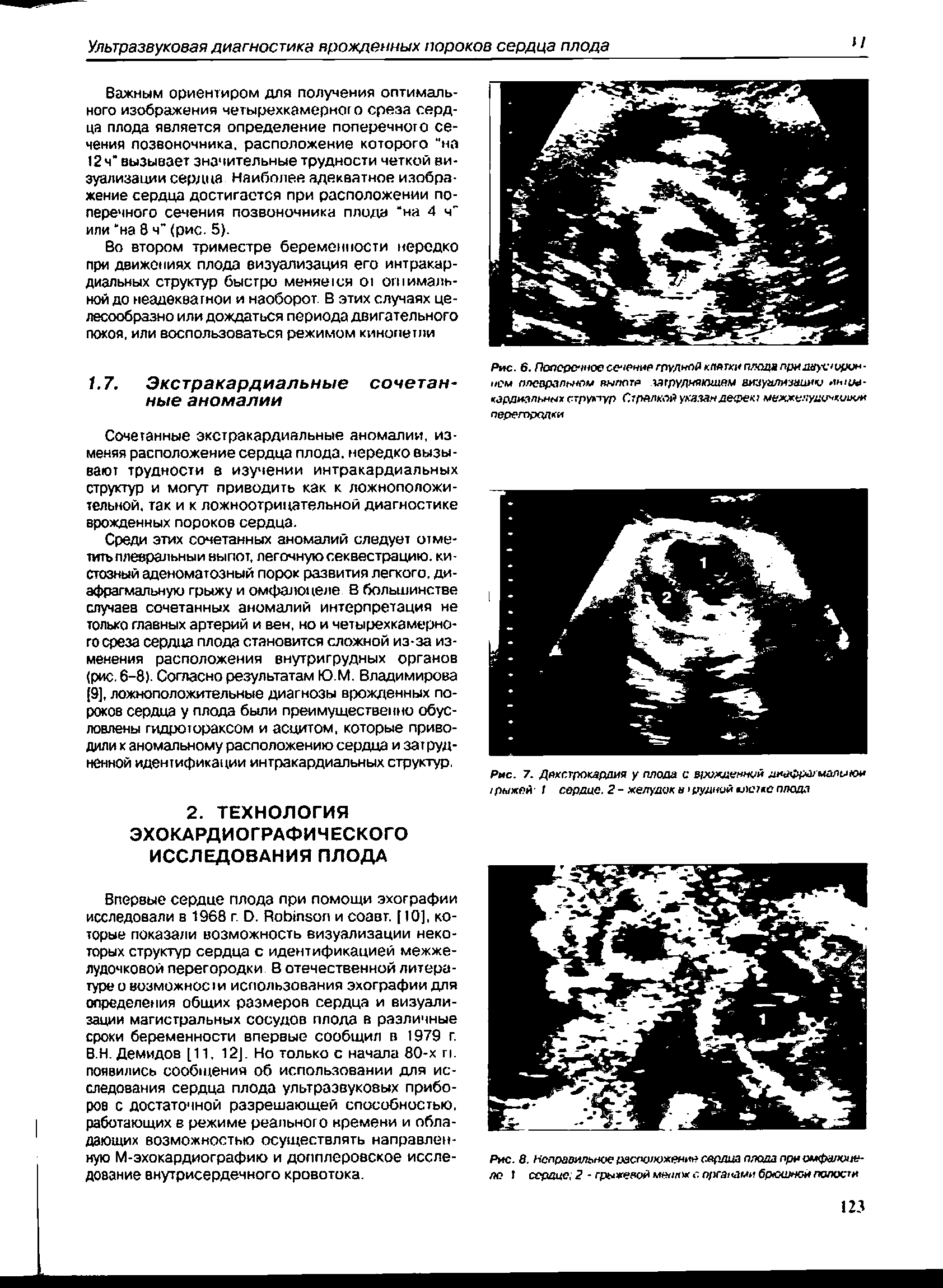 Рис. 6. Попсрсччоесечениегруднпйкгюгкиплодапридвус/орин- см плевралы/ом здлога глуляяюгиям атуализаини мним-кардиальных структур СтрАлмй указам дефекг межжелудц киими перегородки...