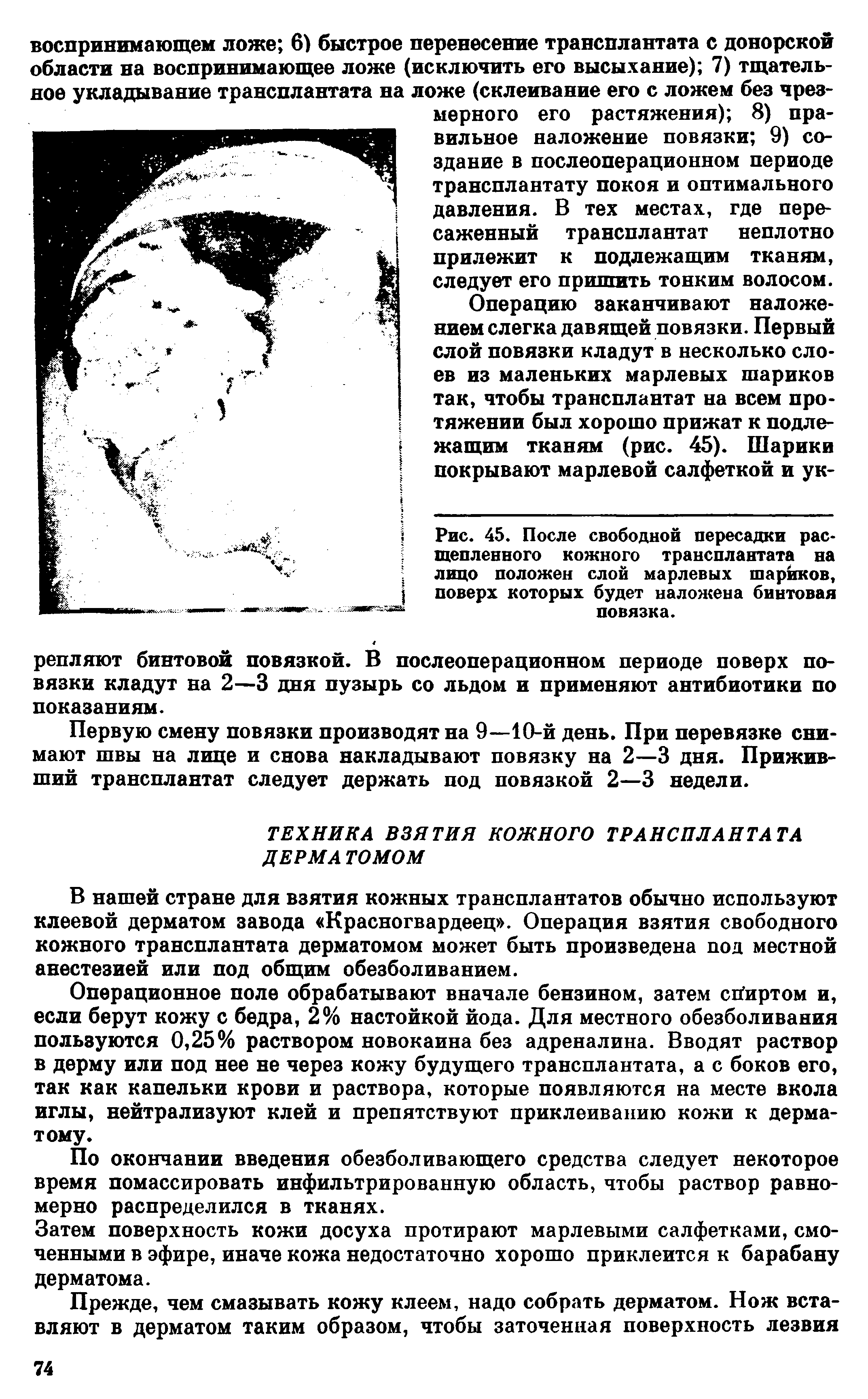 Рис. 45. После свободной пересадки рас тепленного кожного трансплантата на лицо положен слой марлевых шариков, поверх которых будет наложена бинтовая повязка.