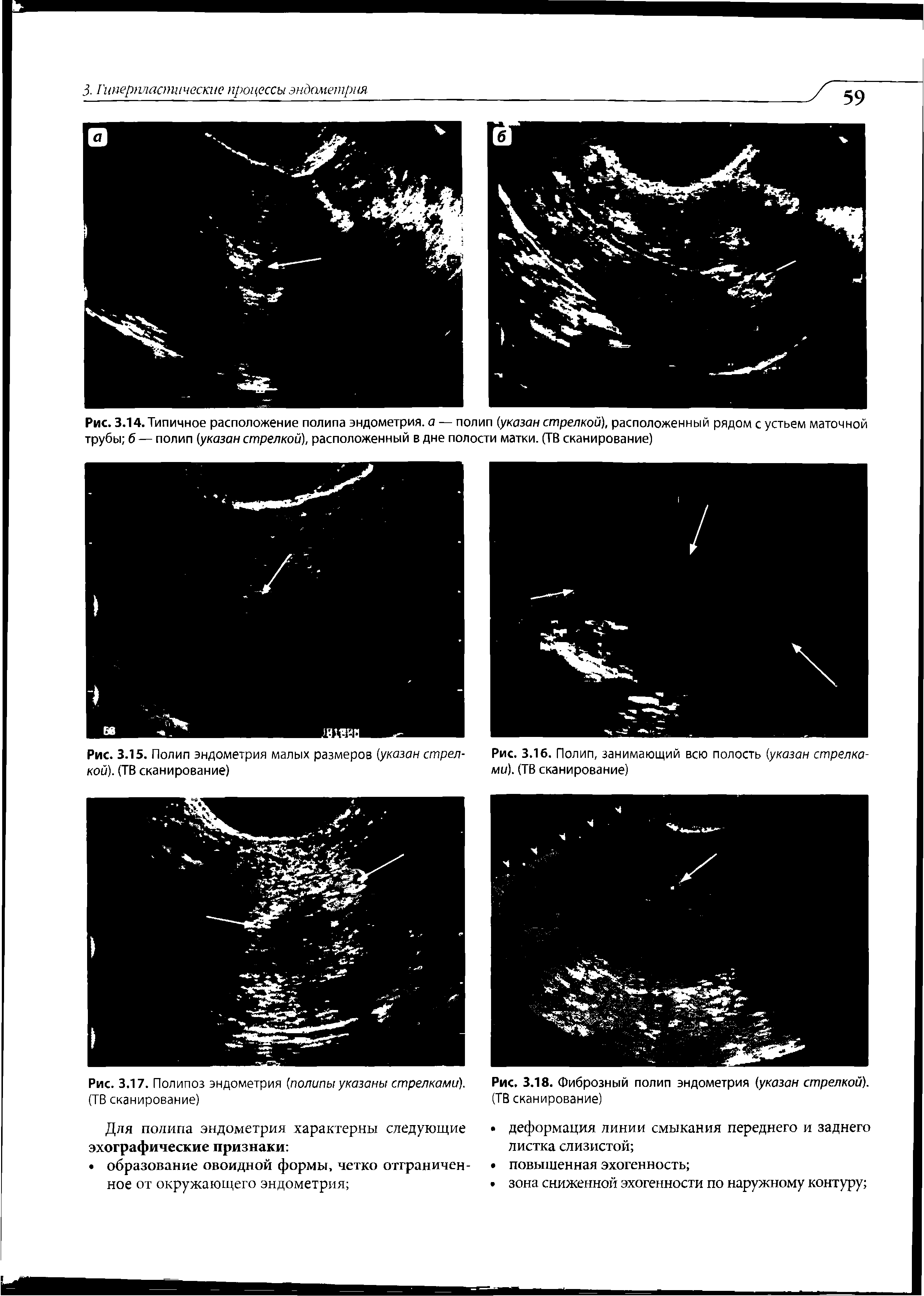 Рис. 3.14. Типичное расположение полипа эндометрия, а — полип (указан стрелкой), расположенный рядом с устьем маточной трубы б — полип (указан стрелкой), расположенный в дне полости матки. (ТВ сканирование)...