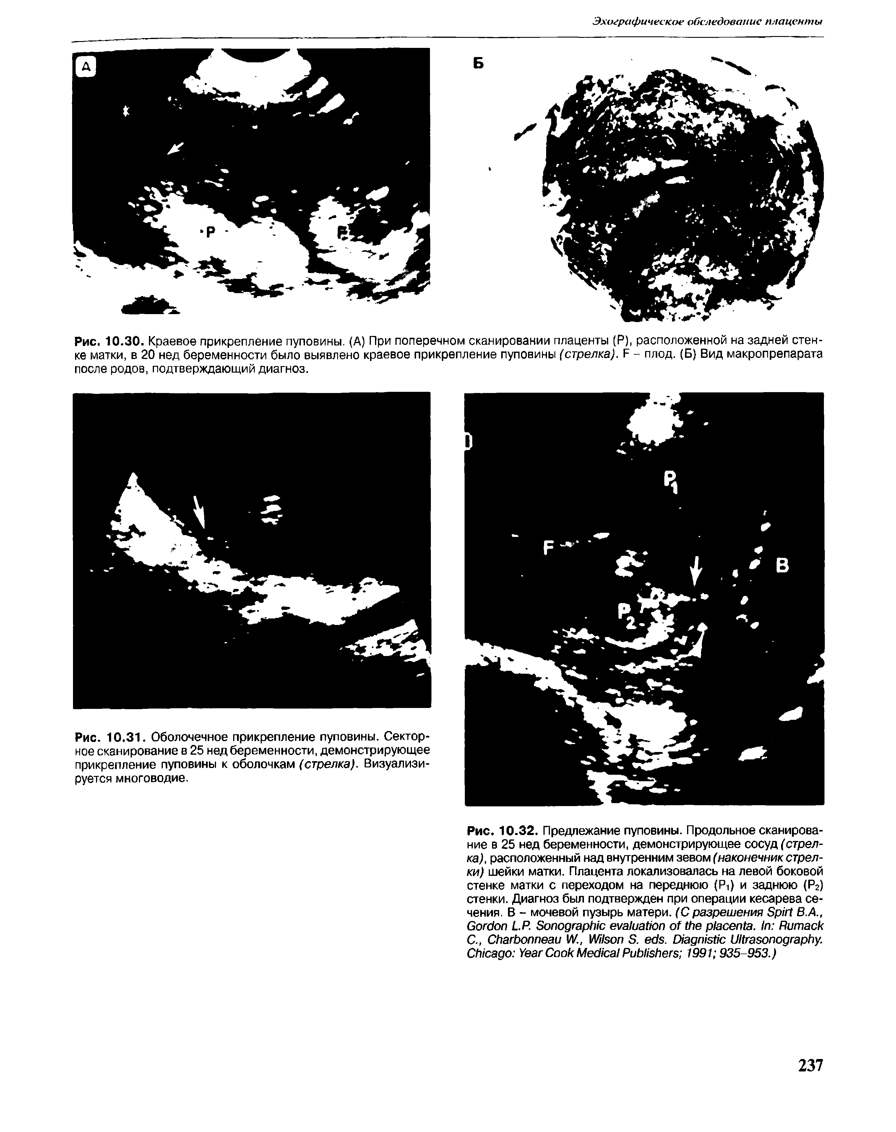 Рис. 10.30. Краевое прикрепление пуповины. (А) При поперечном сканировании плаценты (Р), расположенной на задней стенке матки, в 20 нед беременности было выявлено краевое прикрепление пуповины (стрелка). Е - плод. (Б) Вид макропрепарата после родов, подтверждающий диагноз.