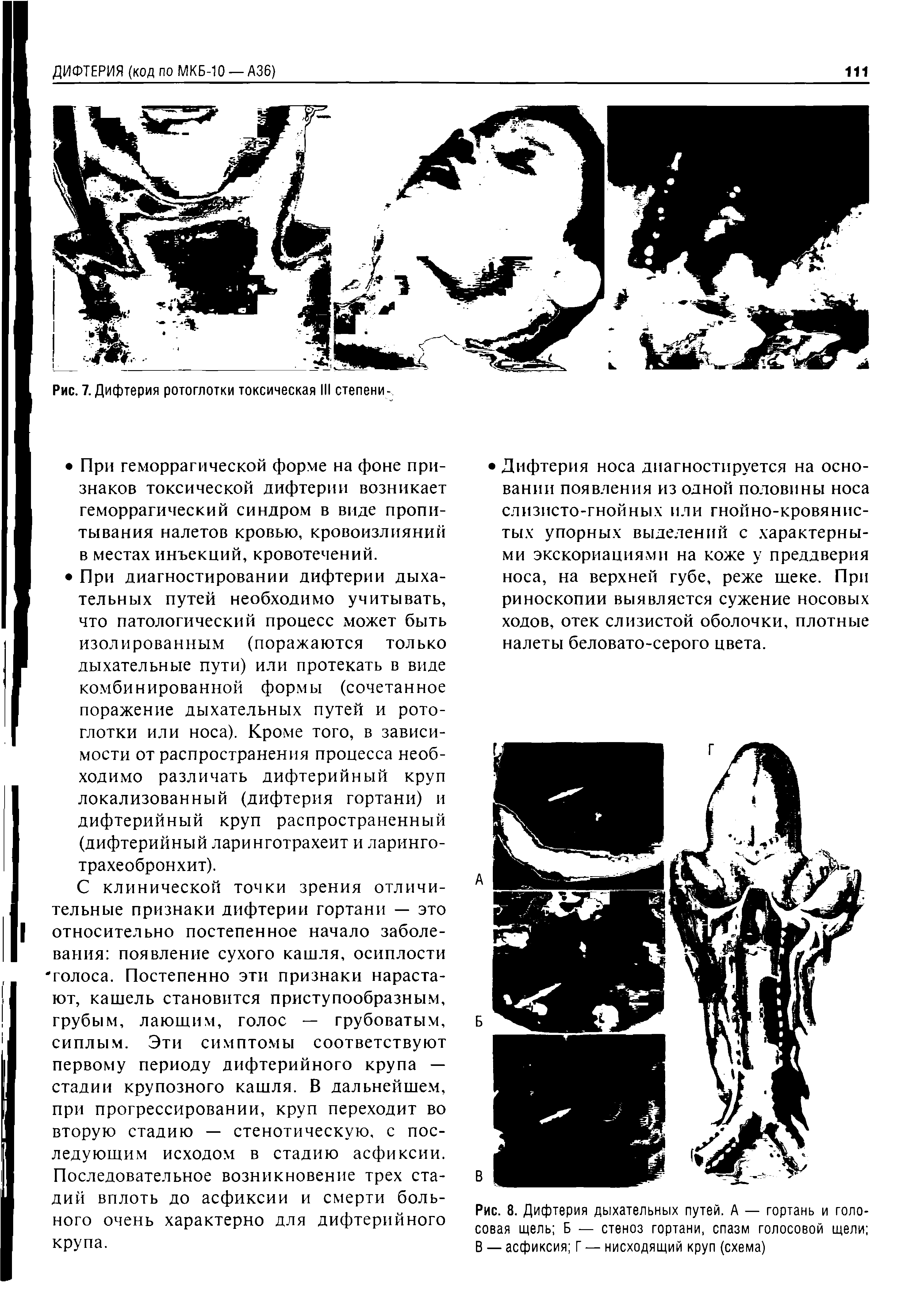 Рис. 8. Дифтерия дыхательных путей. А — гортань и голосовая щель Б — стеноз гортани, спазм голосовой щели В — асфиксия Г — нисходящий круп (схема)...