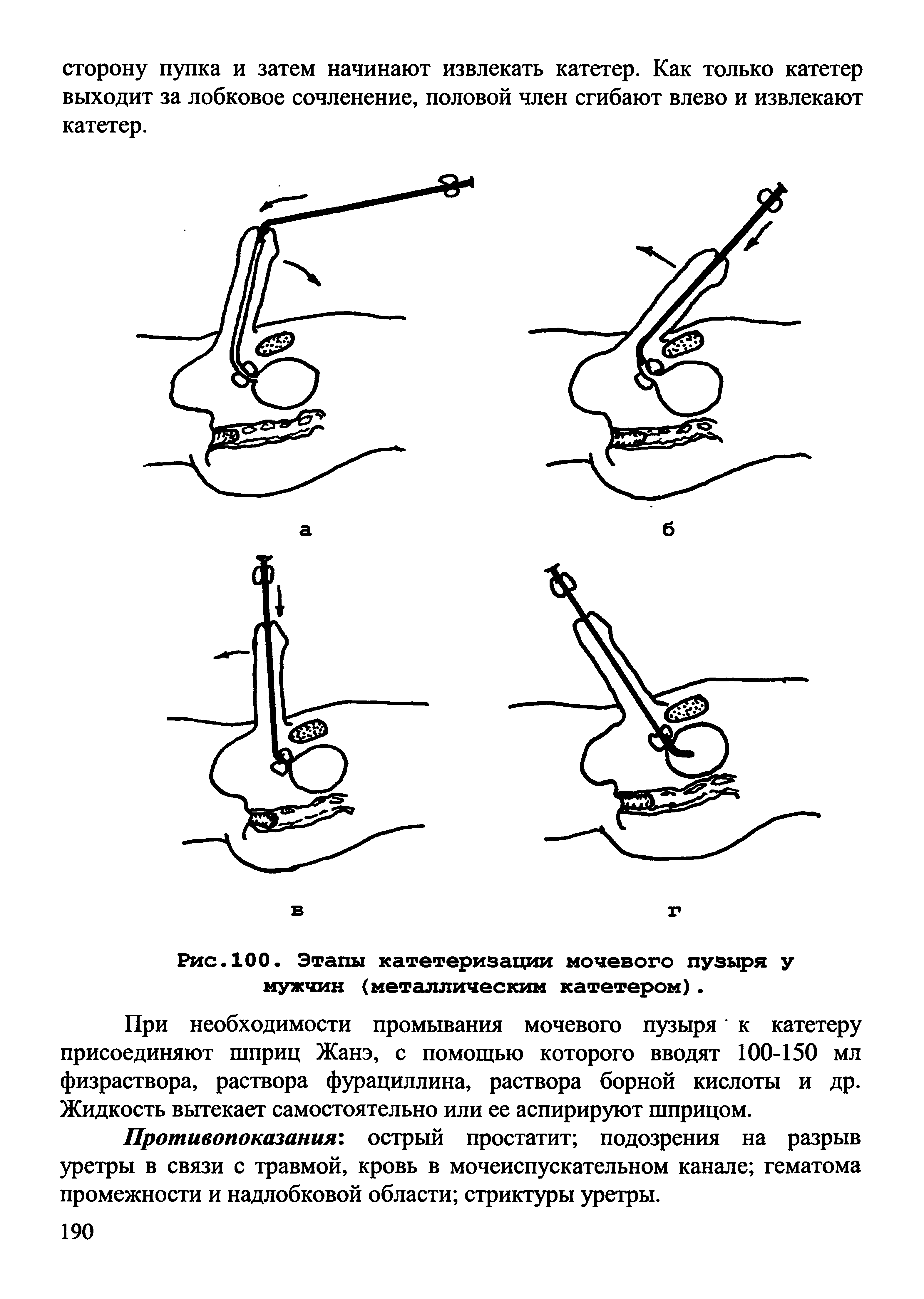 Рис.100. Этапы катетеризации мочевого пузыря у мужчин (металлическим катетером) ...
