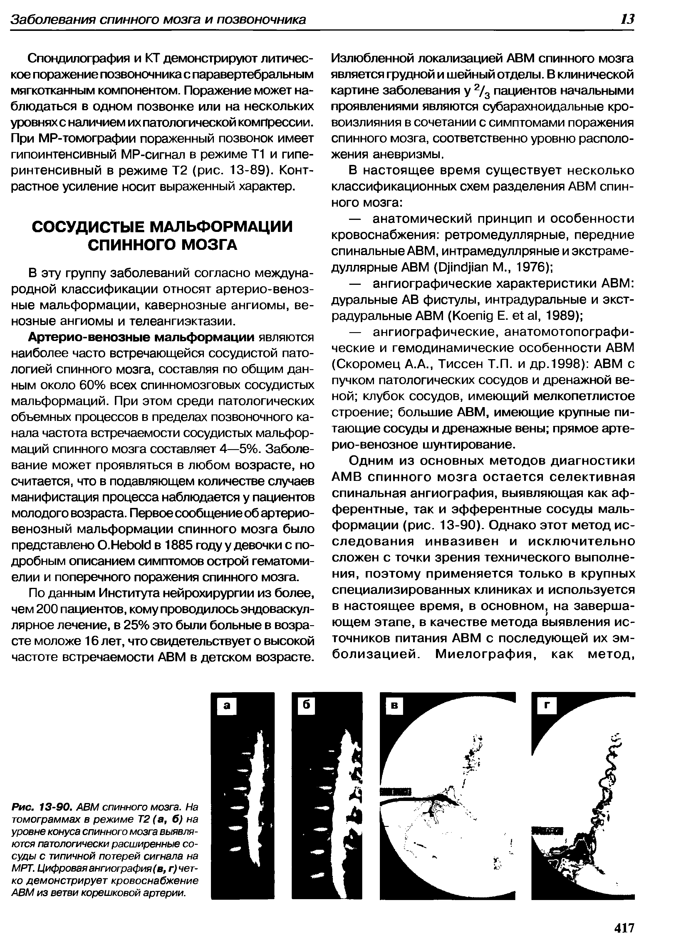 Рис. 13-90. АВМ спинного мозга. На томограммах в режиме Т2 (а, б) на уровне конуса спинного мозга выявляются патологически расширенные сосуды с типичной потерей сигнала на МРТ. Цифровая ангиография (в, четко демонстрирует кровоснабжение АВМ из ветви корешковой артерии.