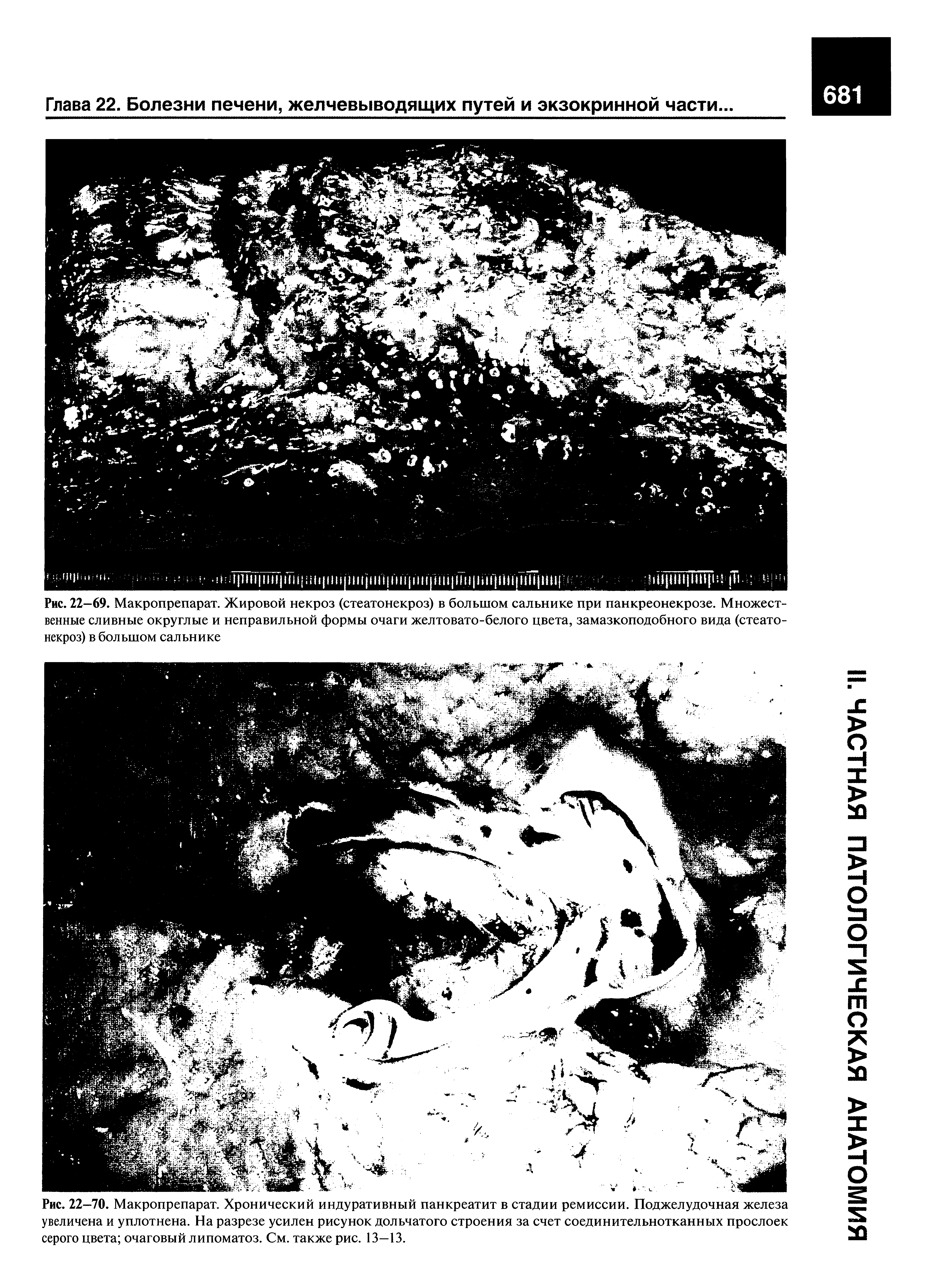 Рис. 22-69. Макропрепарат. Жировой некроз (стеатонекроз) в большом сальнике при панкреонекрозе. Множественные сливные округлые и неправильной формы очаги желтовато-белого цвета, замазкоподобного вида (стеатонекроз) в большом сальнике...