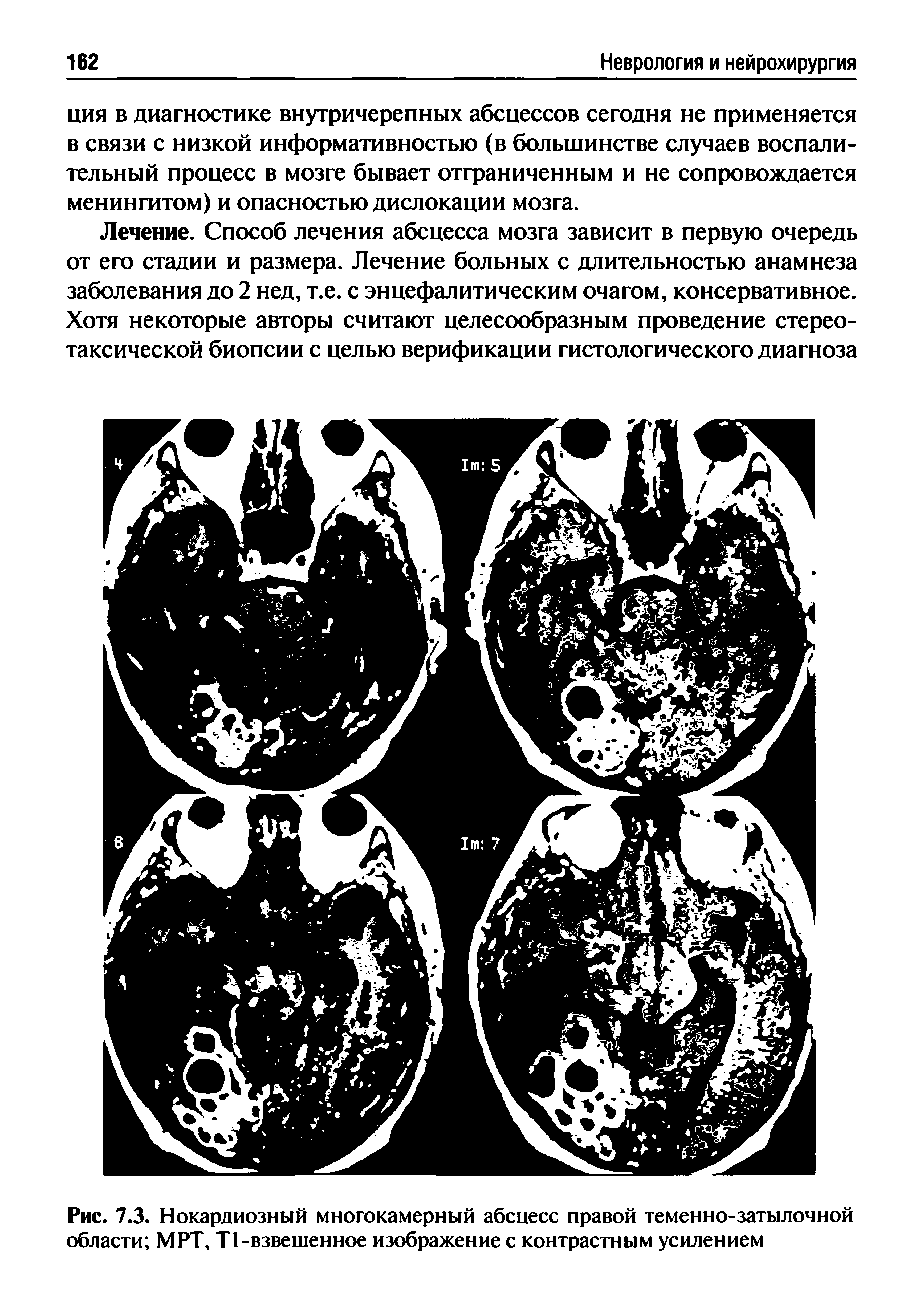 Рис. 7.3. Нокардиозный многокамерный абсцесс правой теменно-затылочной области MPT, Т1-взвешенное изображение с контрастным усилением...