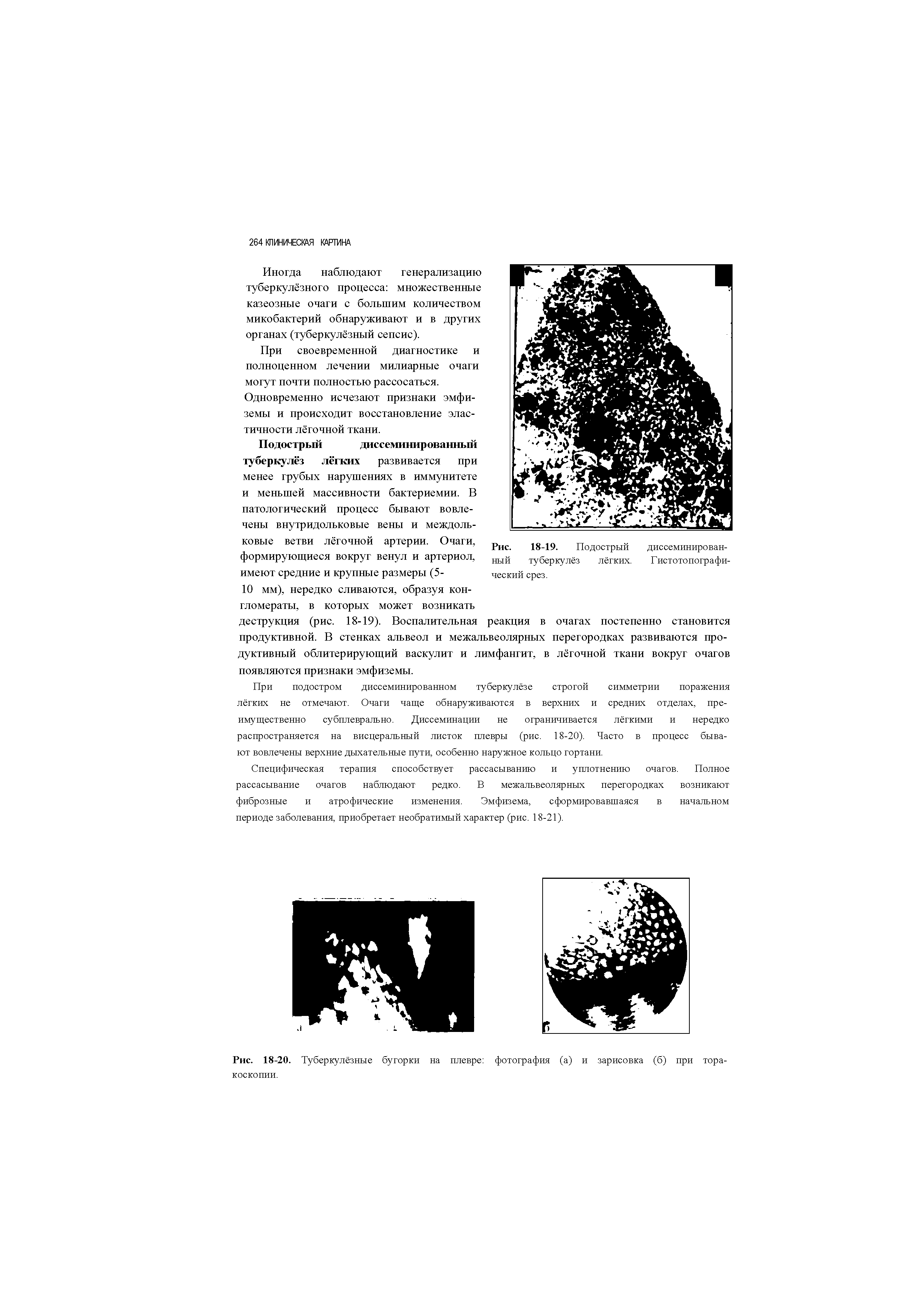 Рис. 18-19. Подострый диссеминированный туберкулёз лёгких. Гистотопографи-ческий срез.