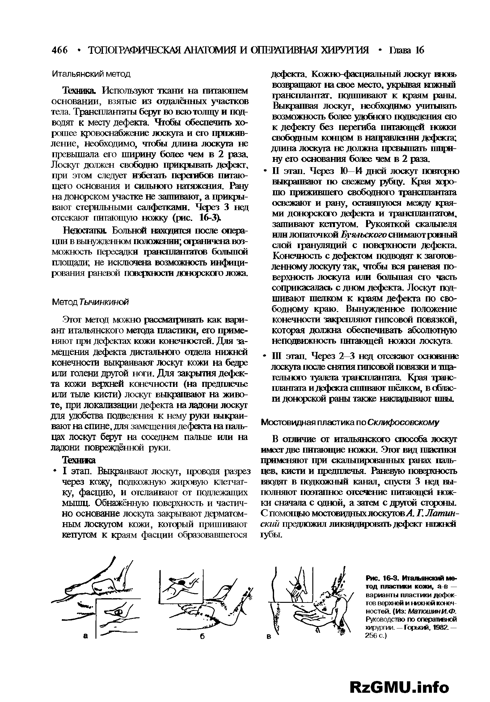 Рис. 16-3. Итальянский метод пластики кожи, а-в — варианты пластики дефектов верхней и нижней конечностей. (Из Матюшин И. Ф. Руководство по оперативной хирургии. — Горьким, 1982. — 256 с.)...