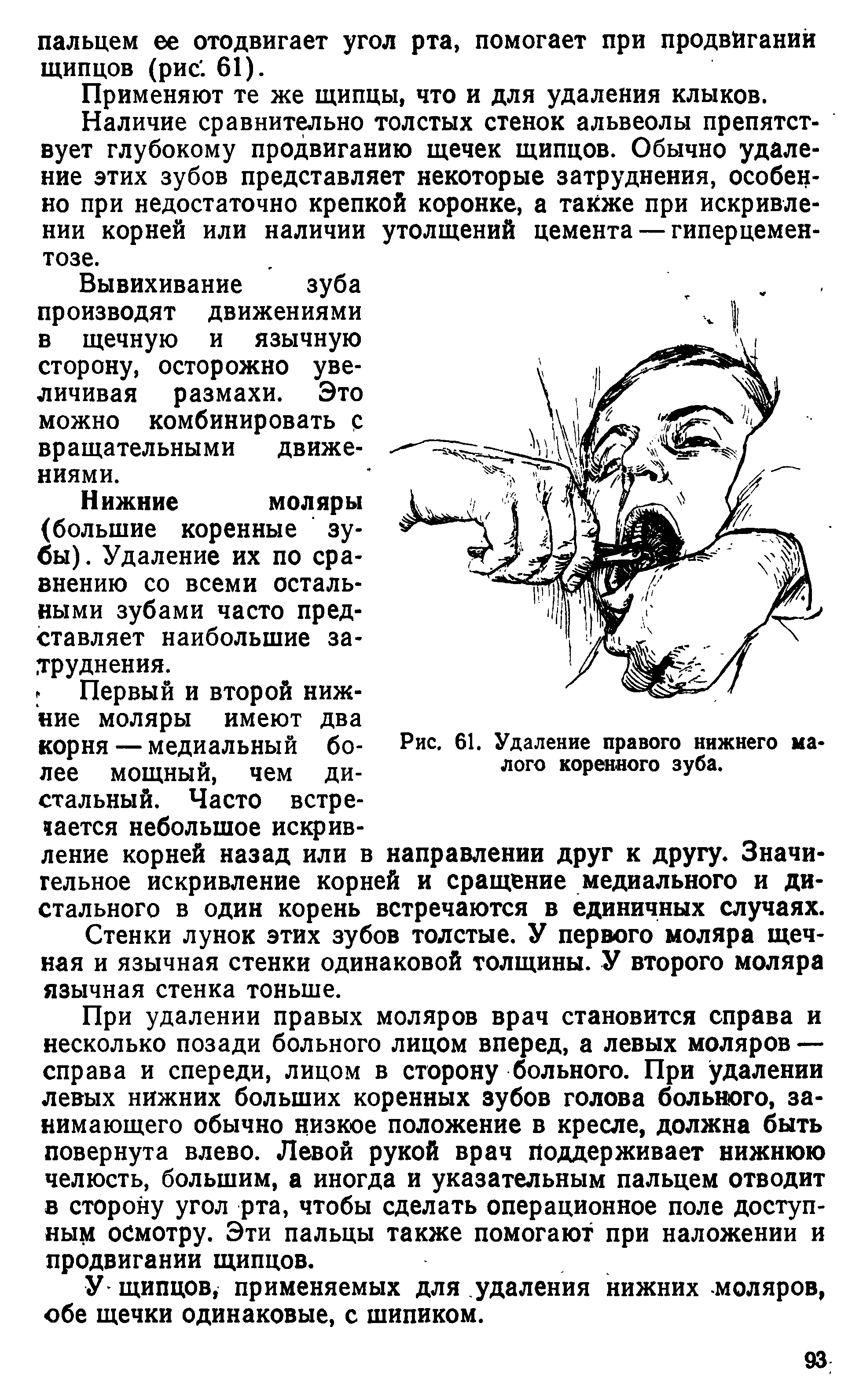 Рис. 61. Удаление правого нижнего малого коренного зуба.