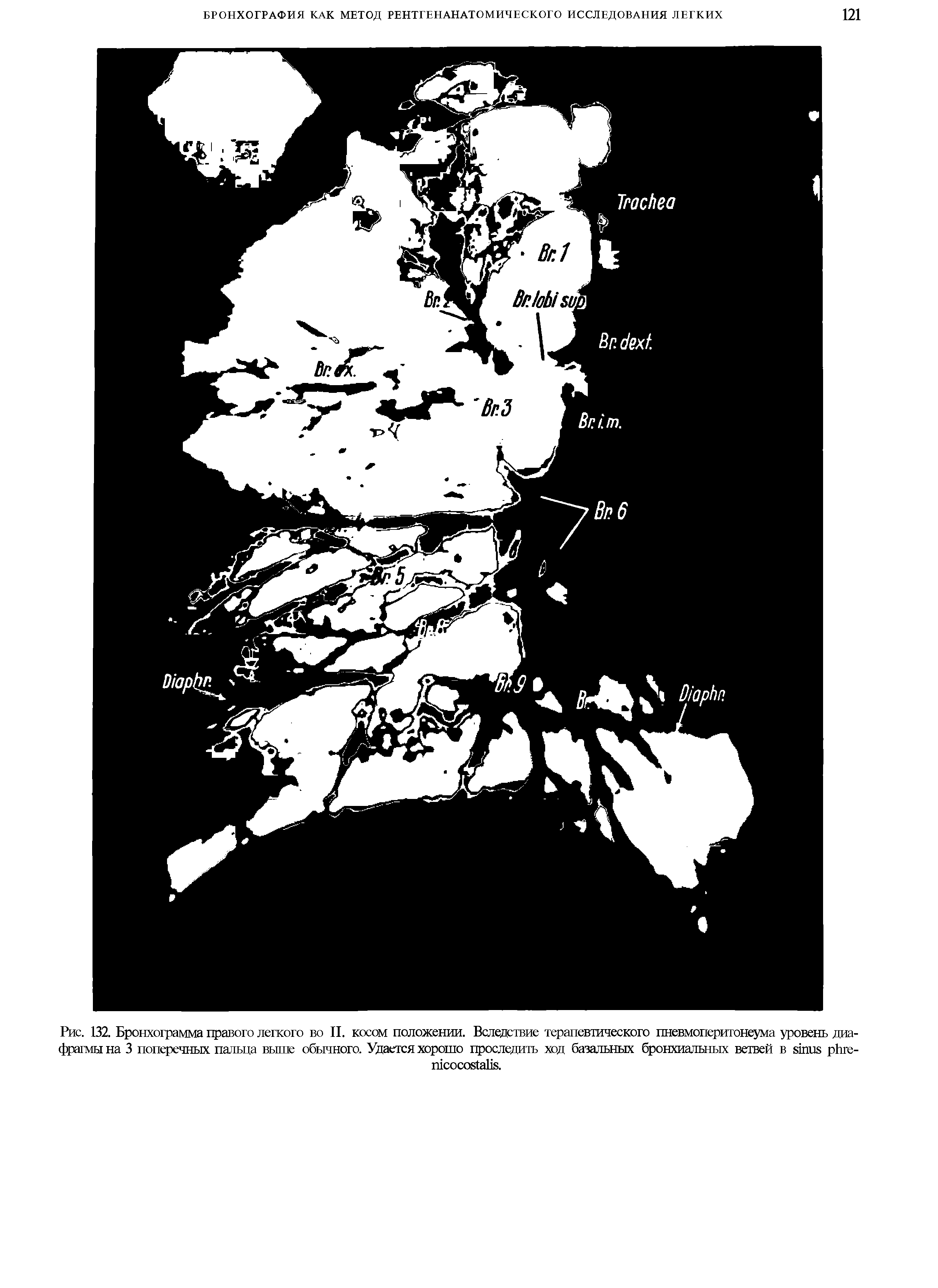 Рис. 132. Бронхограмма правого легкого во II. косом положении. Вследствие терапевтического пневмоперитонеума уровень диафрагмы на 3 поперечных пальца выше обычного. Удается хорошо проследить ход базальных бронхиальных ветвей в - .