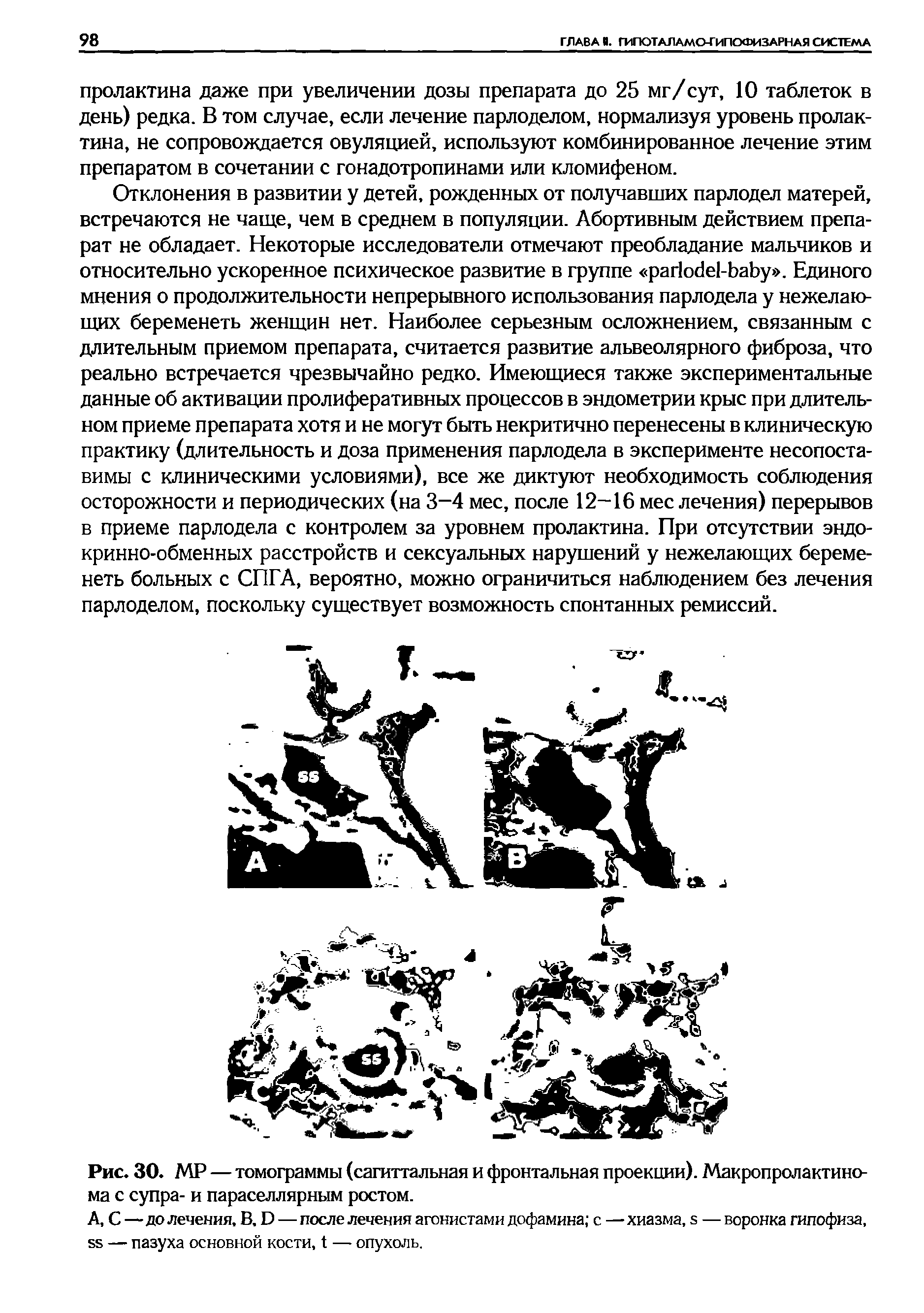 Рис. 30. МР — томограммы (сагиттальная и фронтальная проекции). Макропролактинома с супра- и параселлярным ростом.