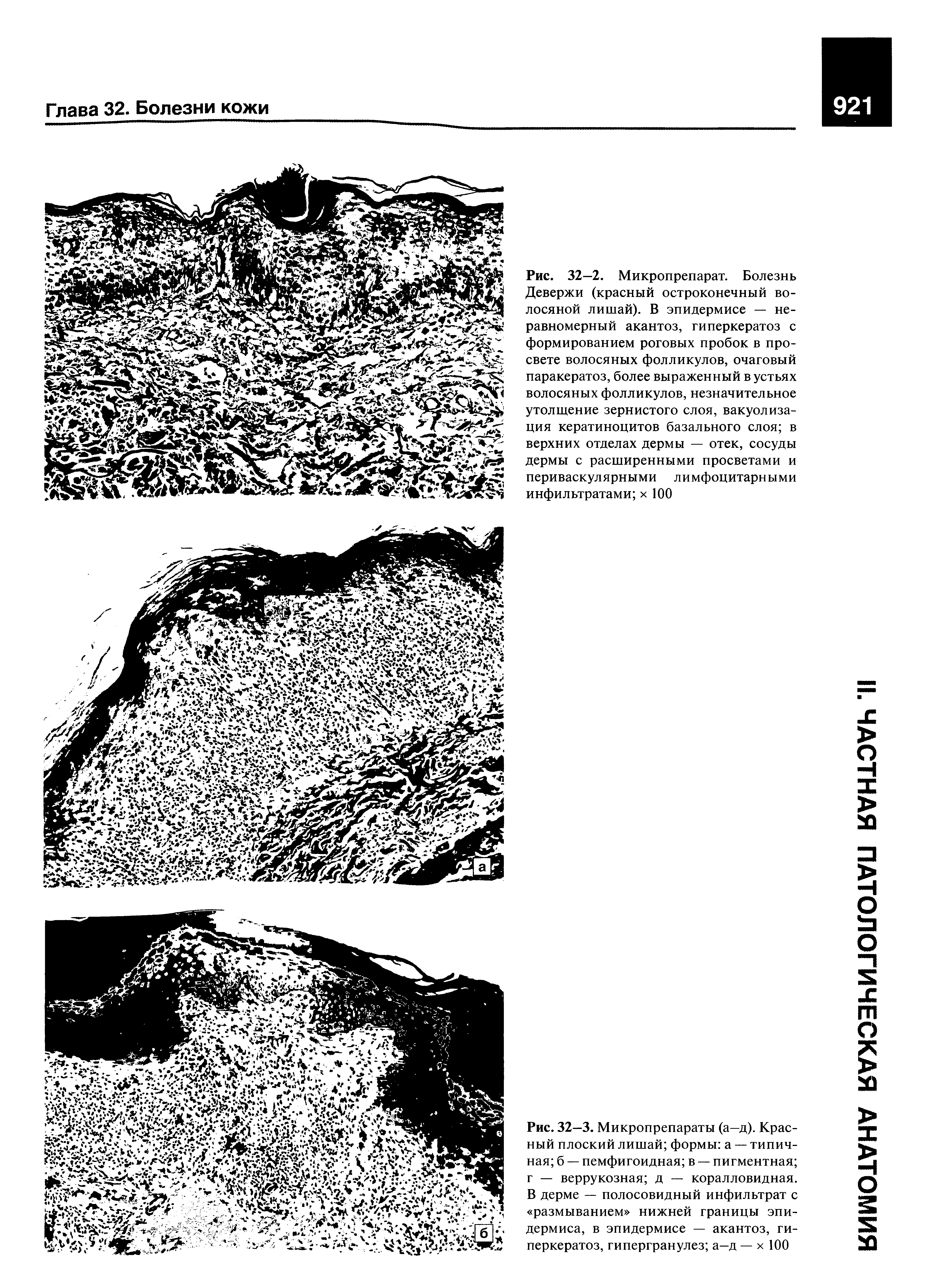 Рис. 32—3. Микропрепараты (а—д). Красный плоский лишай формы а — типичная б — пемфигоидная в — пигментная г — веррукозная д — коралловидная. В дерме — полосовидный инфильтрат с размыванием нижней границы эпидермиса, в эпидермисе — акантоз, гиперкератоз, гипергранулез а—д — х 100...