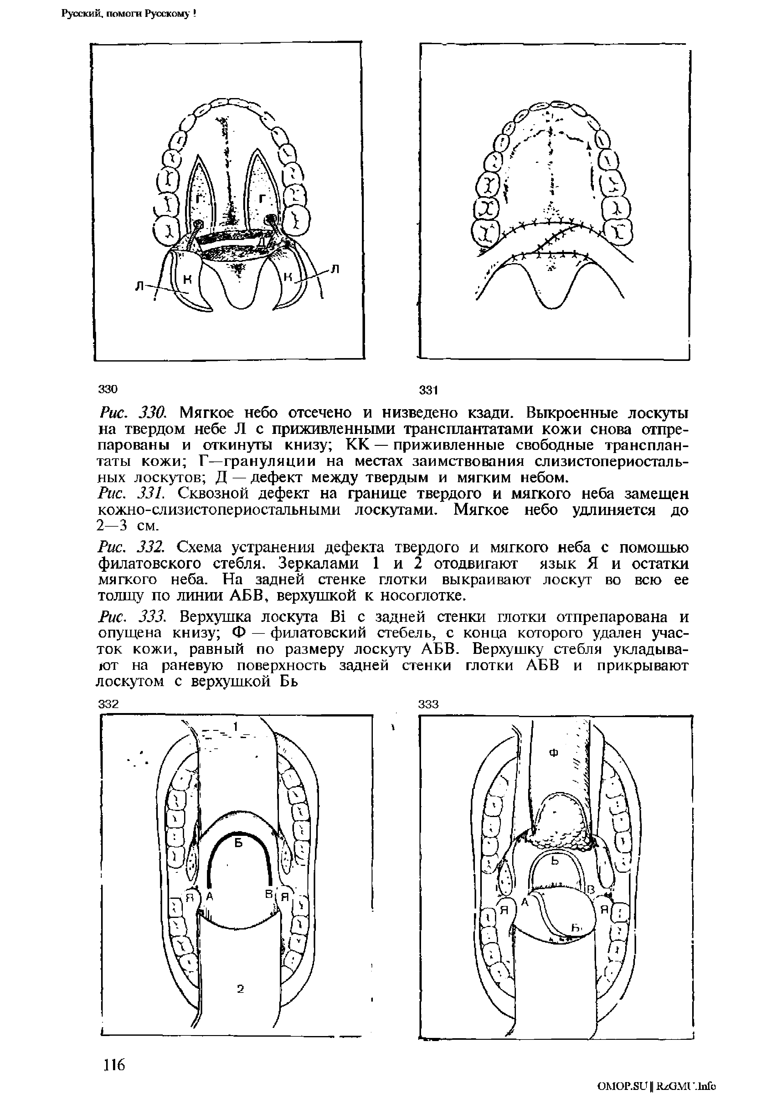Рис. 333. Верхушка лоскута В1 с задней стенки глотки отпрепарована и опущена книзу Ф — филатовский стебель, с конца которого удален участок кожи, равный по размеру лоскуту АБВ. Верхушку стебля укладывают на раневую поверхность задней стенки глотки АБВ и прикрывают...
