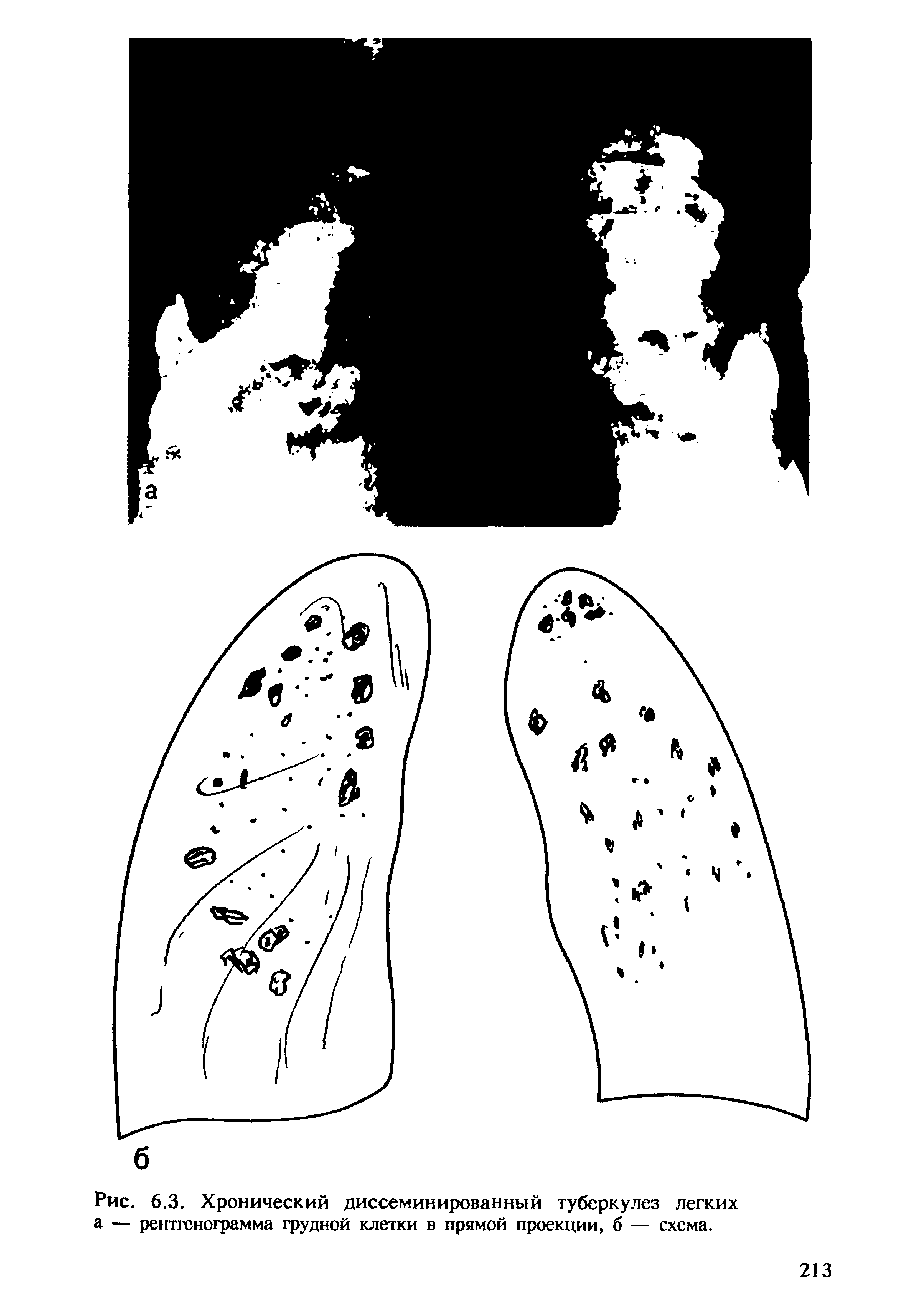Рис. 6.3. Хронический диссеминированный туберкулез легких а — рентгенограмма грудной клетки в прямой проекции, б — схема.