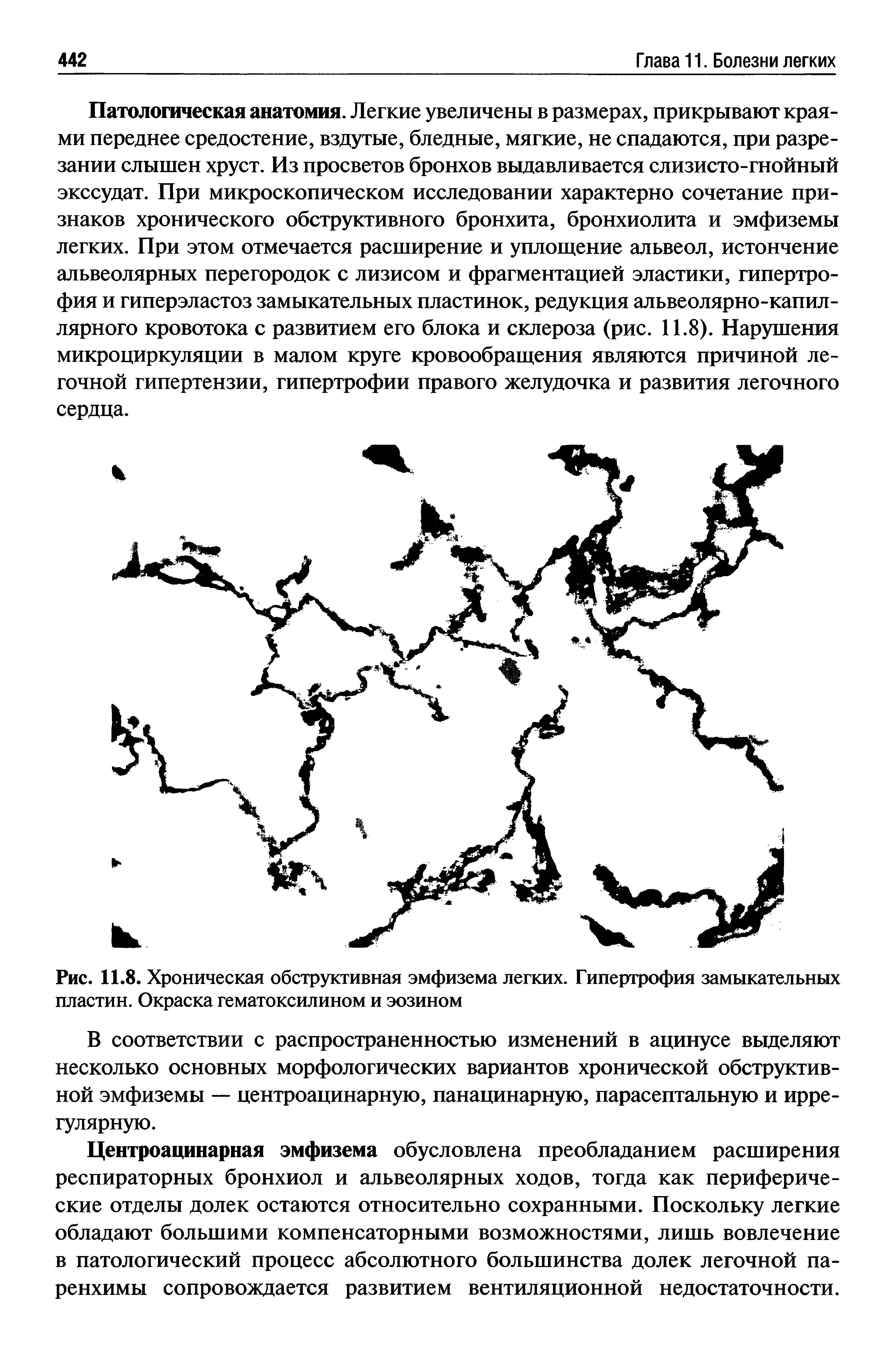 Рис. 11.8. Хроническая обструктивная эмфизема легких. Гипертрофия замыкательных пластин. Окраска гематоксилином и эозином...