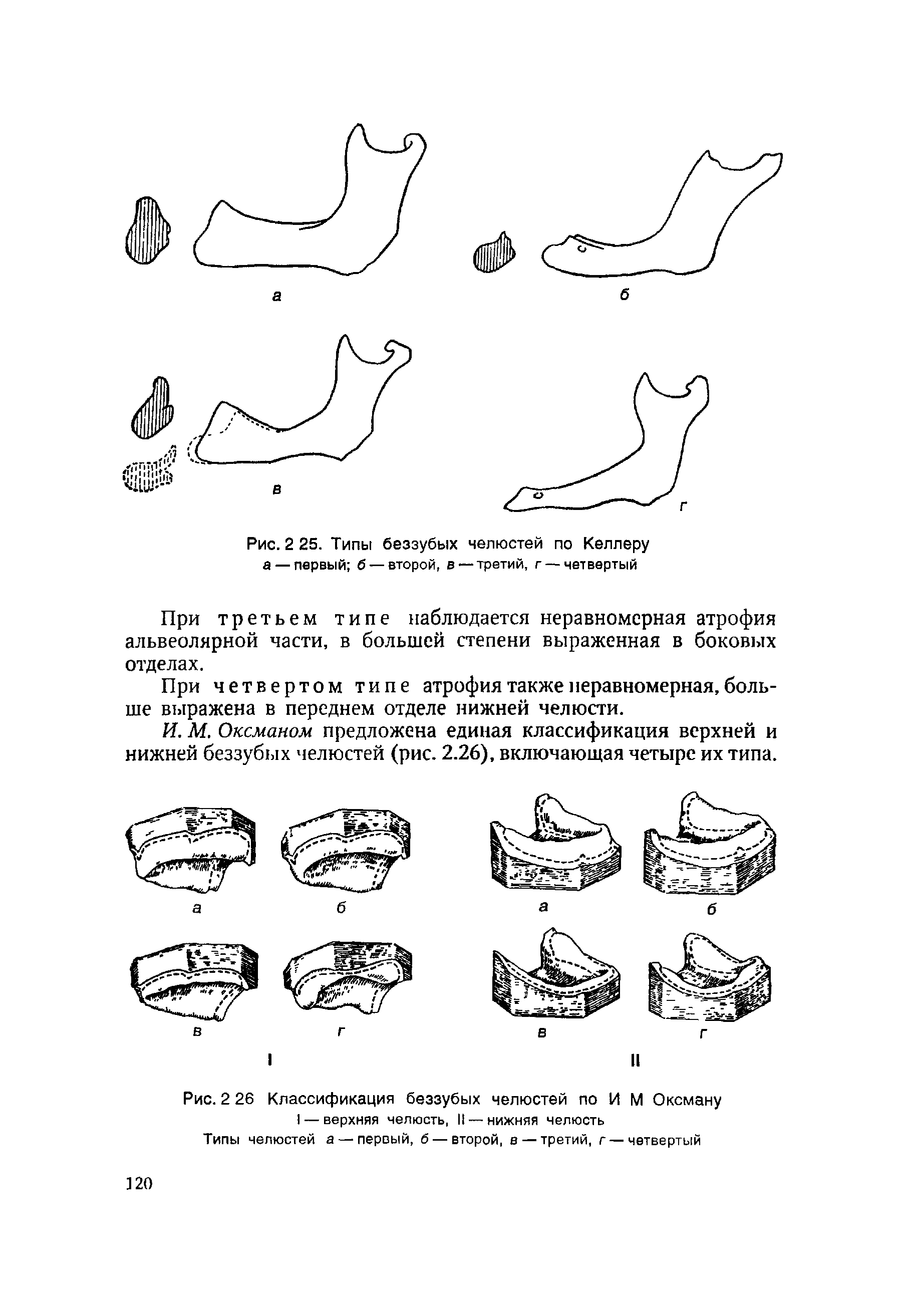 Рис. 2 26 Классификация беззубых челюстей по И М Оксману I — верхняя челюсть, II — нижняя челюсть...