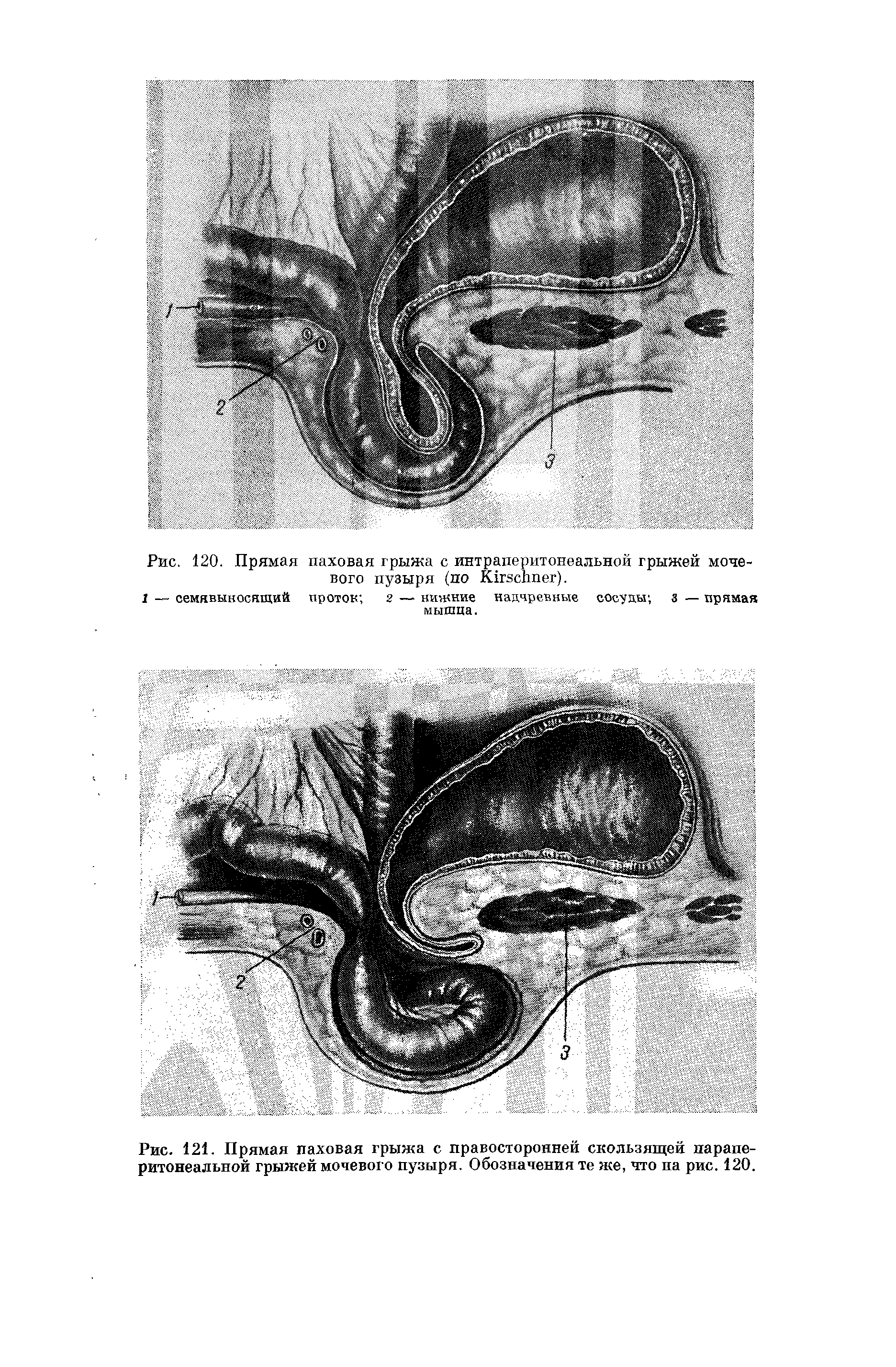 Рис. 121. Прямая паховая грыжа с правосторонней скользящей парапе-ритонеальной грыжей мочевого пузыря. Обозначения те же, что па рис. 120.