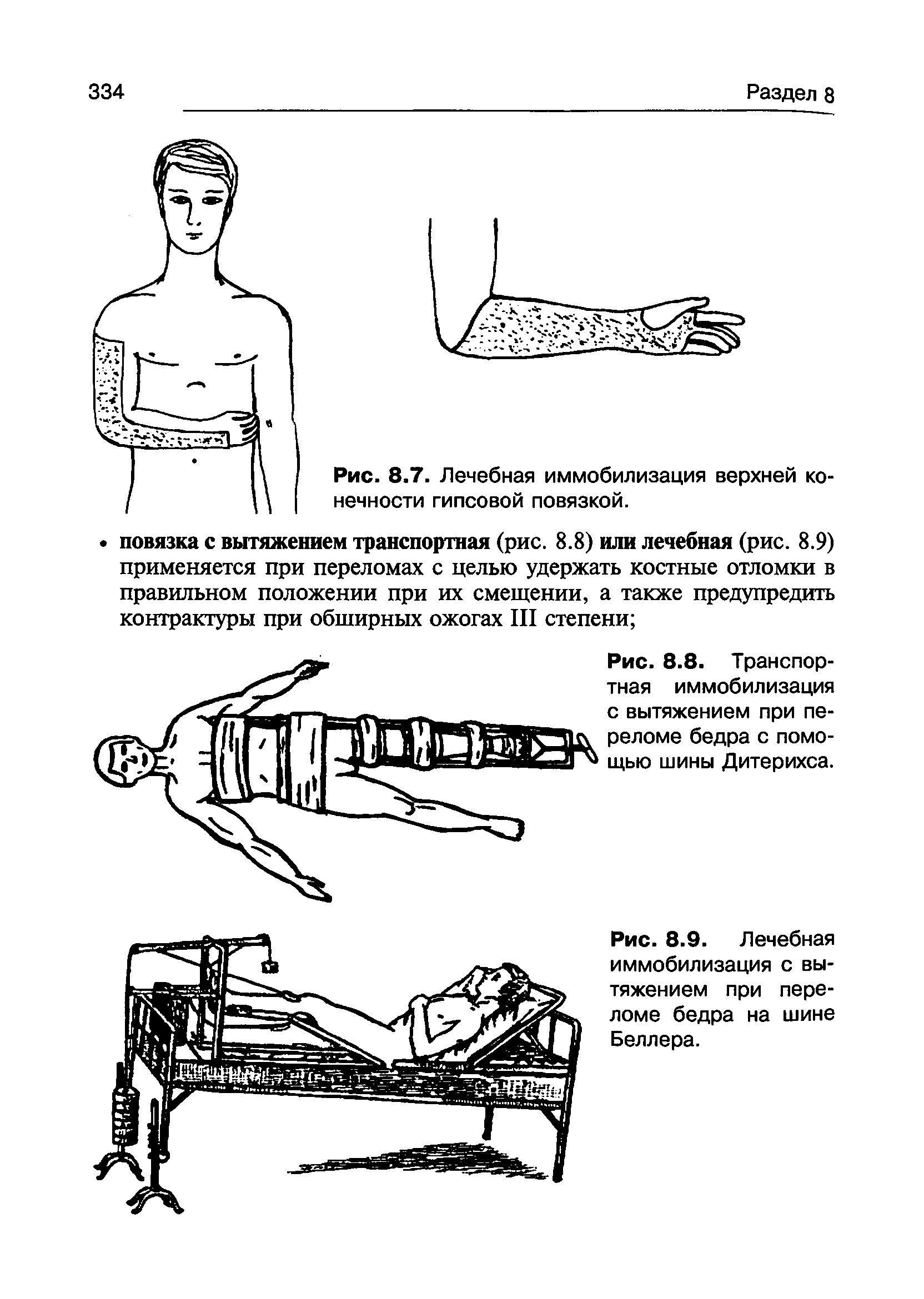 Рис. 8.8. Транспортная иммобилизация с вытяжением при переломе бедра с помощью шины Дитерихса.