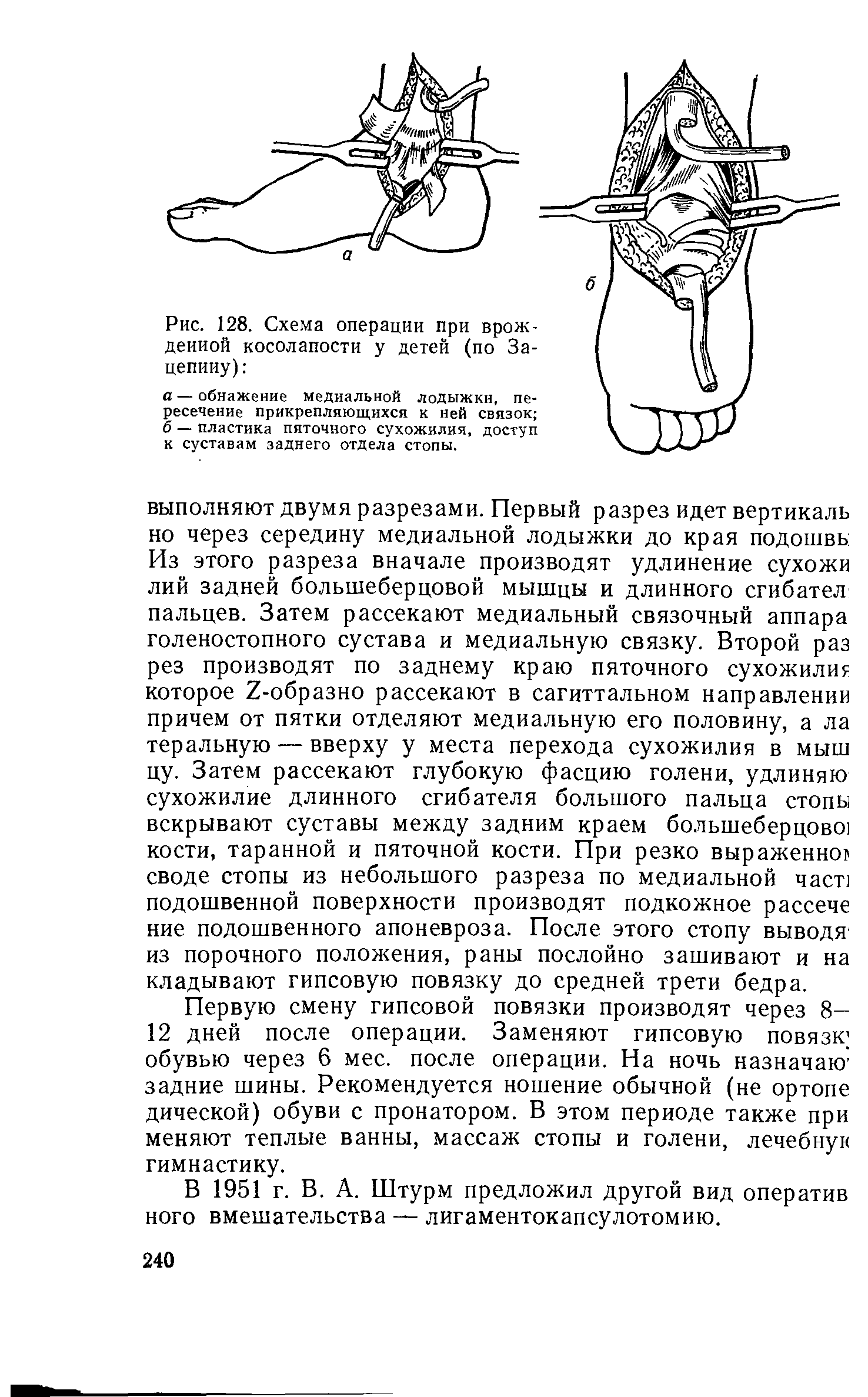 Рис. 128. Схема операции при врожденной косолапости у детей (по Зацепину) ...