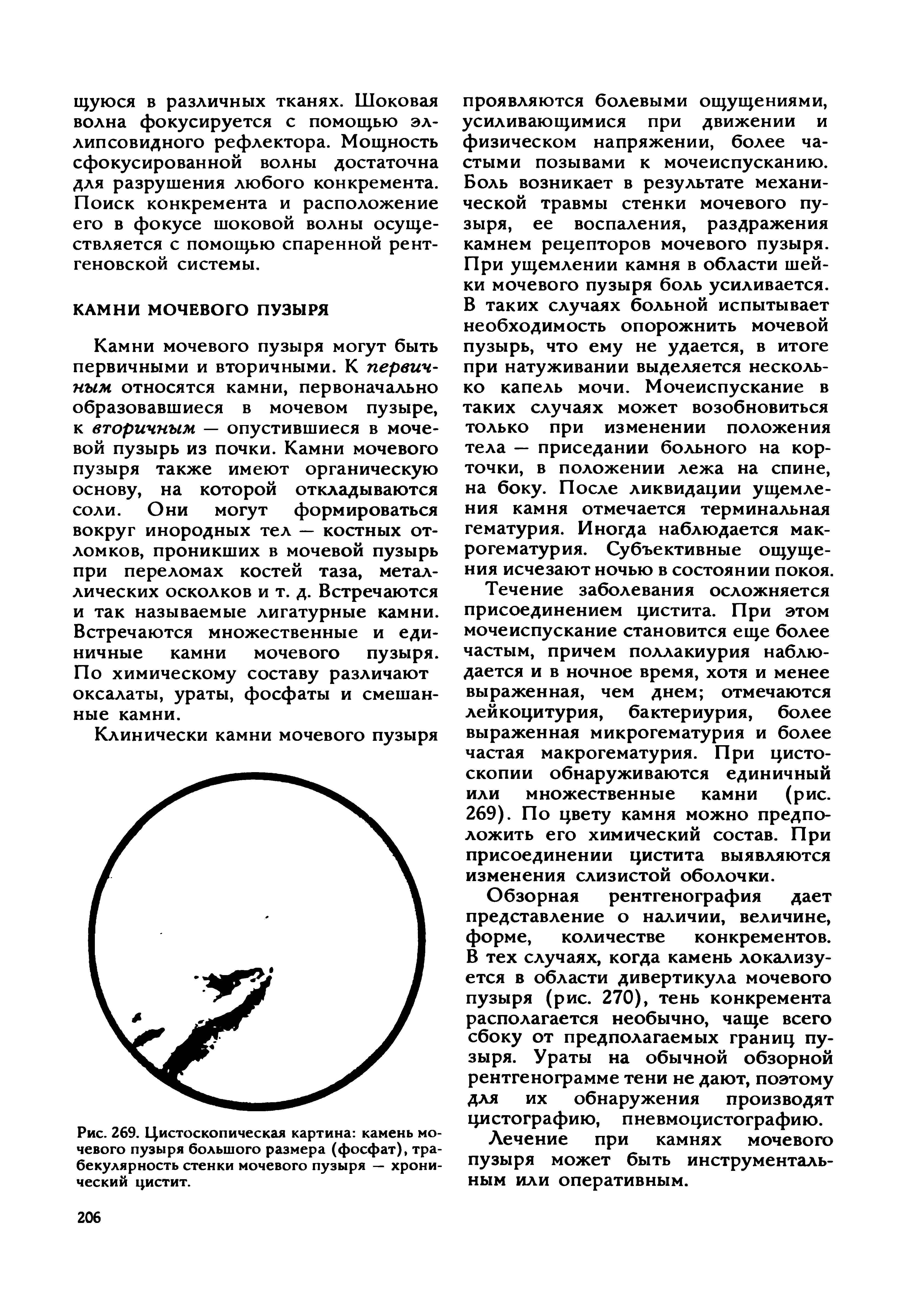 Рис. 269. Цистоскопическая картина камень мочевого пузыря большого размера (фосфат), тра-бекулярность стенки мочевого пузыря — хронический цистит.