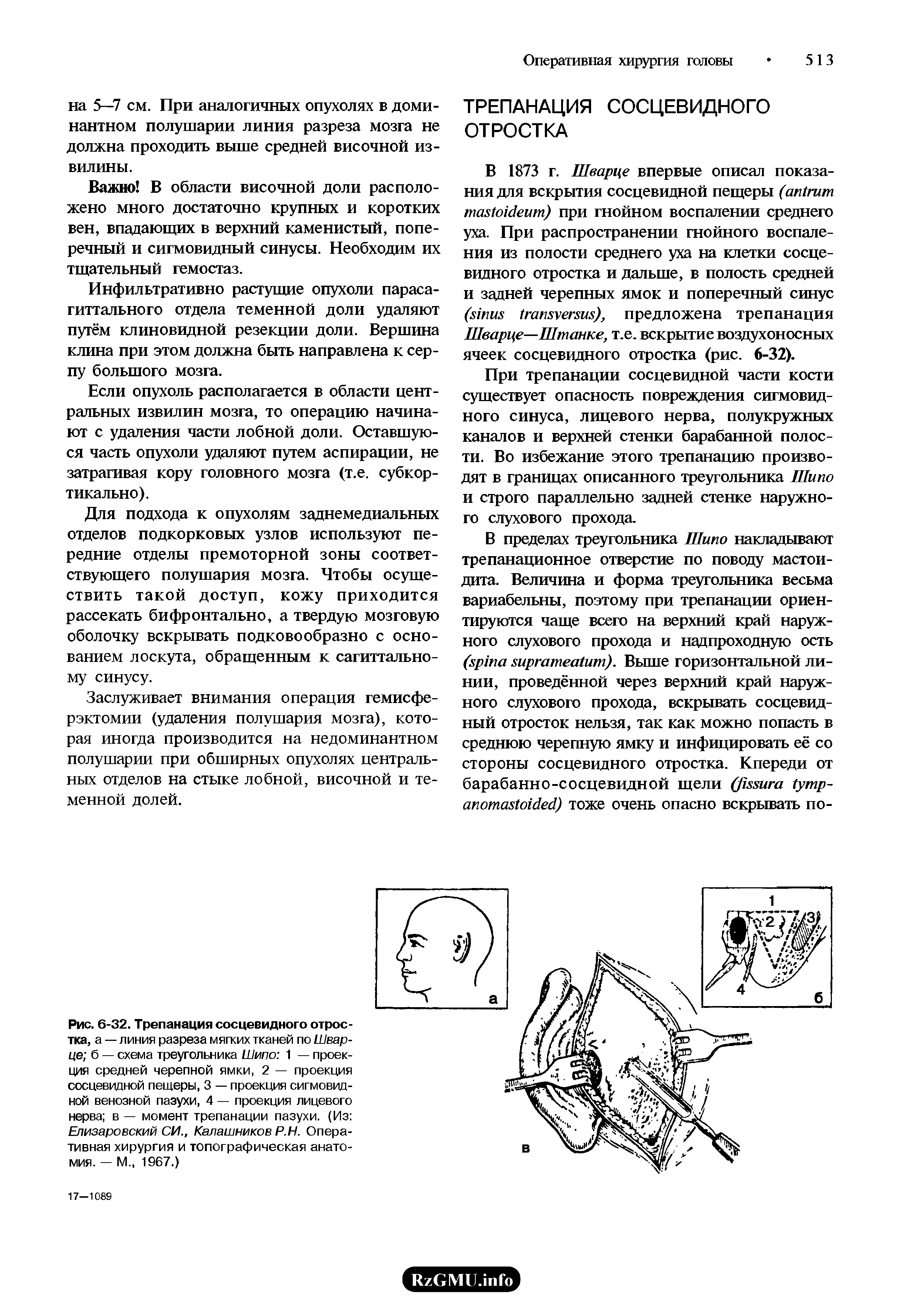 Рис. 6-32. Трепанация сосцевидного отростка, а — линия разреза мягких тканей по Шварце б — схема треугольника Шипо 1 — проекция средней черепной ямки, 2 — проекция сосцевидной пещеры, 3 — проекция сигмовидной венозной пазухи, 4 — проекция лицевого нерва в — момент трепанации пазухи. (Из Елизаровский СИ., Калашников Р.Н. Оперативная хирургия и топографическая анатомия. — М., 1967.)...