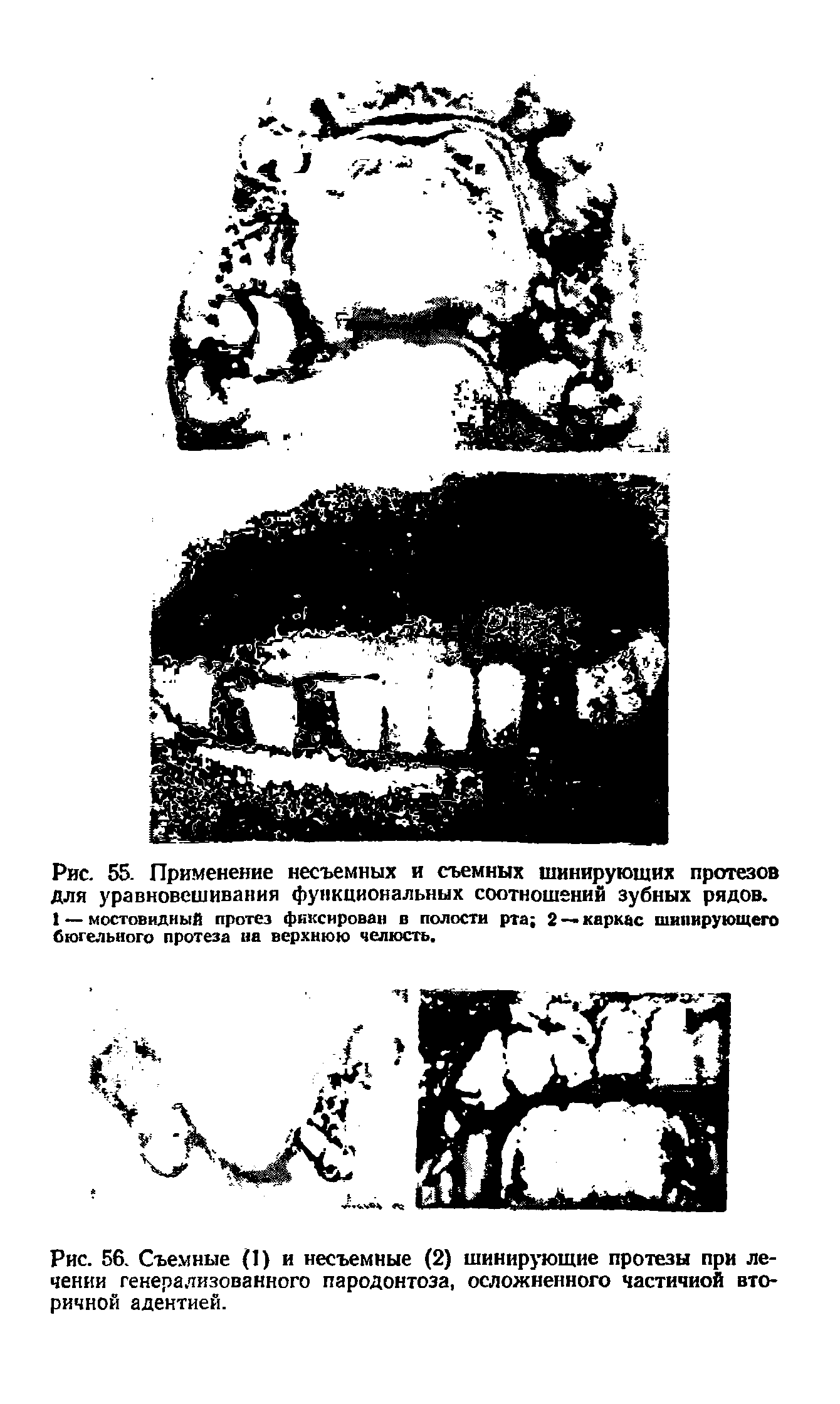 Рис. 56. Съемные (1) и несъемные (2) шинирующие протезы при лечении генерализованного пародонтоза, осложненного частичной вторичной адентией.