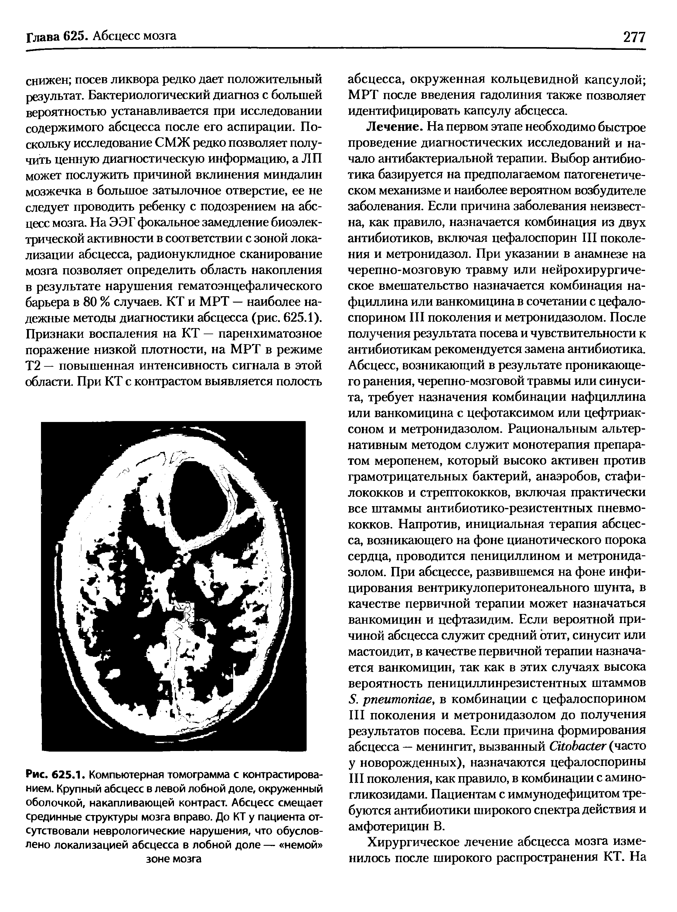 Рис. 625.1. Компьютерная томограмма с контрастированием. Крупный абсцесс в левой лобной доле, окруженный оболочкой, накапливающей контраст. Абсцесс смещает срединные структуры мозга вправо. До КТ у пациента отсутствовали неврологические нарушения, что обусловлено локализацией абсцесса в лобной доле — немой зоне мозга...