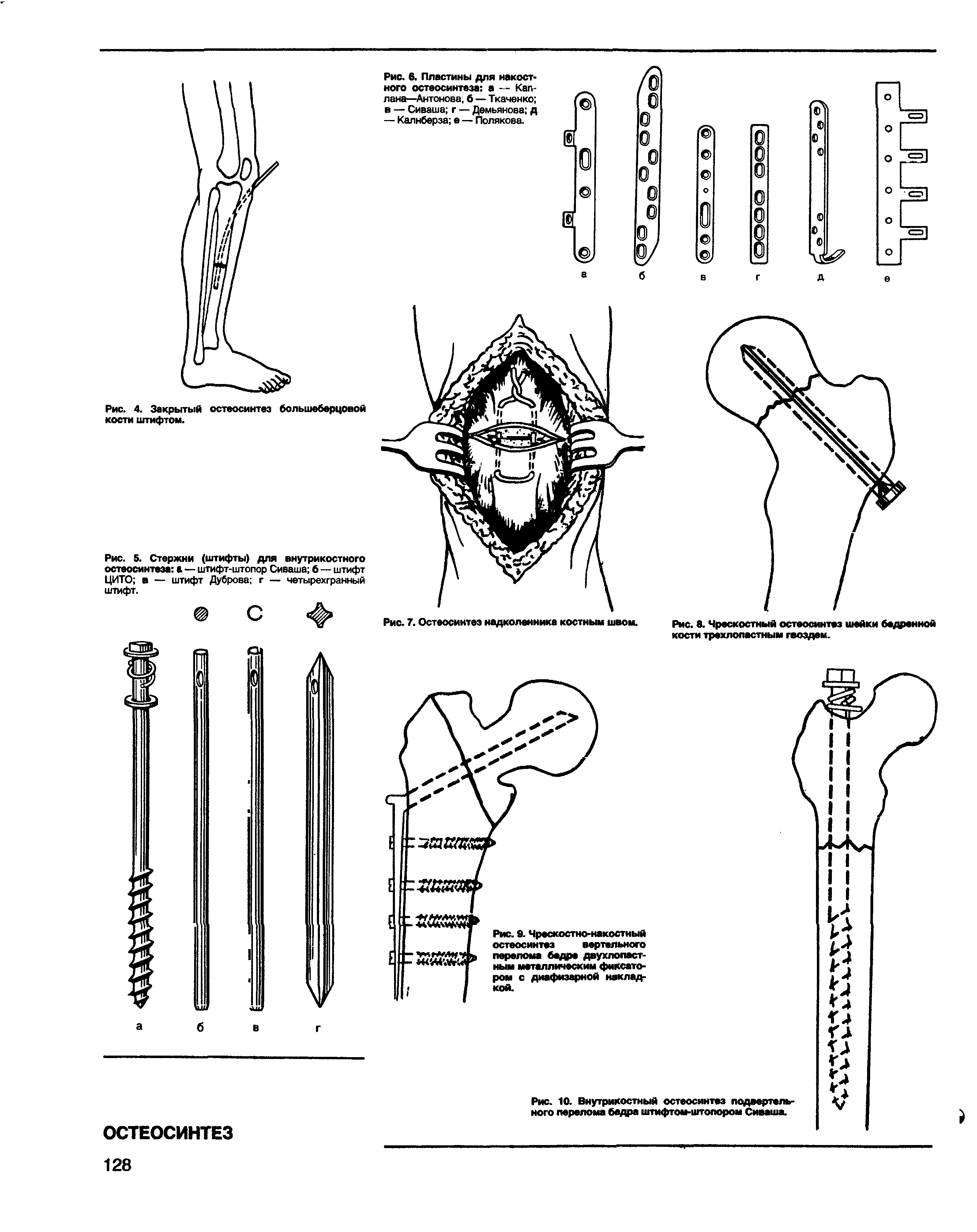 Рис. 5. Стержни (штифты) для внутрикостного остеосинтеза а — штифт-штопор Сиваша б — штифт ЦИТО в — штифт Дуброва г — четырехгранный штифт.