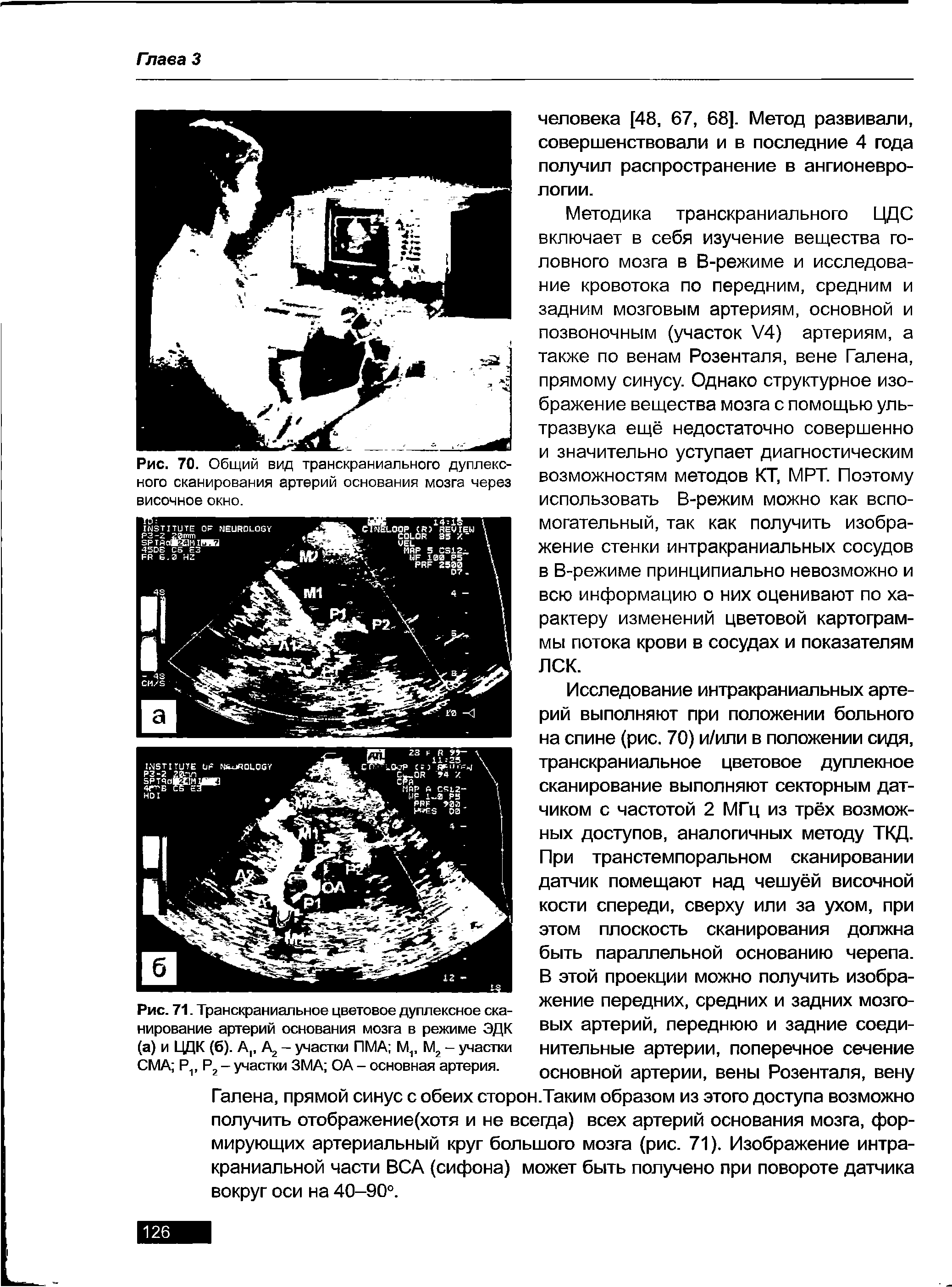 Рис. 71. Транскраниальное цветовое дуплексное сканирование артерий основания мозга в режиме ЭДК (а) и ЦДК (6). Ар А2 - участки ПМА Мр М2 - участки СМА Рг Р2 - участки ЗМА ОА - основная артерия.