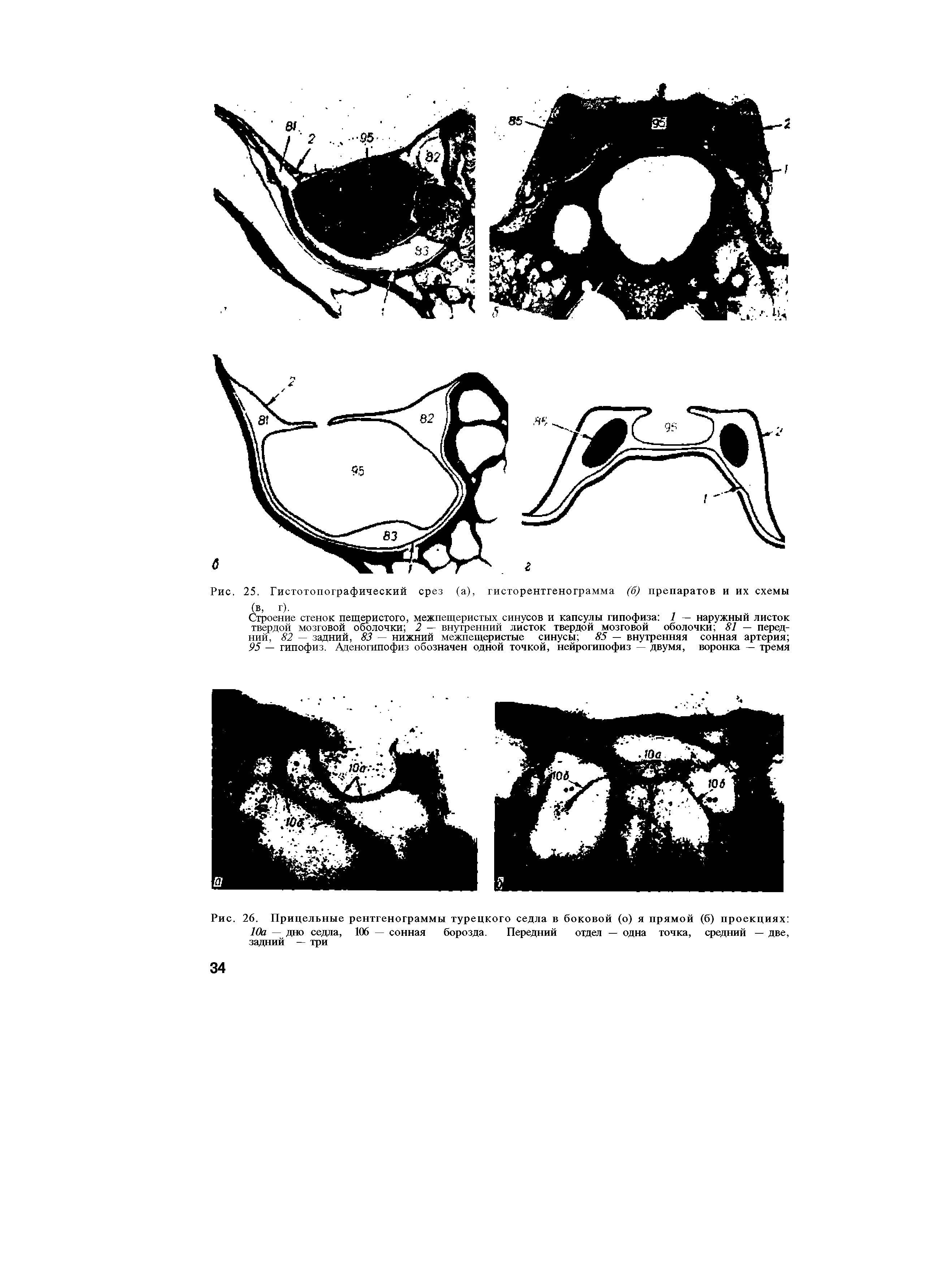 Рис. 26. Прицельные рентгенограммы турецкого седла в боковой (о) я прямой (б) проекциях 10а — дно седла, 106 — сонная борозда. Передний отдел — одна точка, средний — две, задний — три...