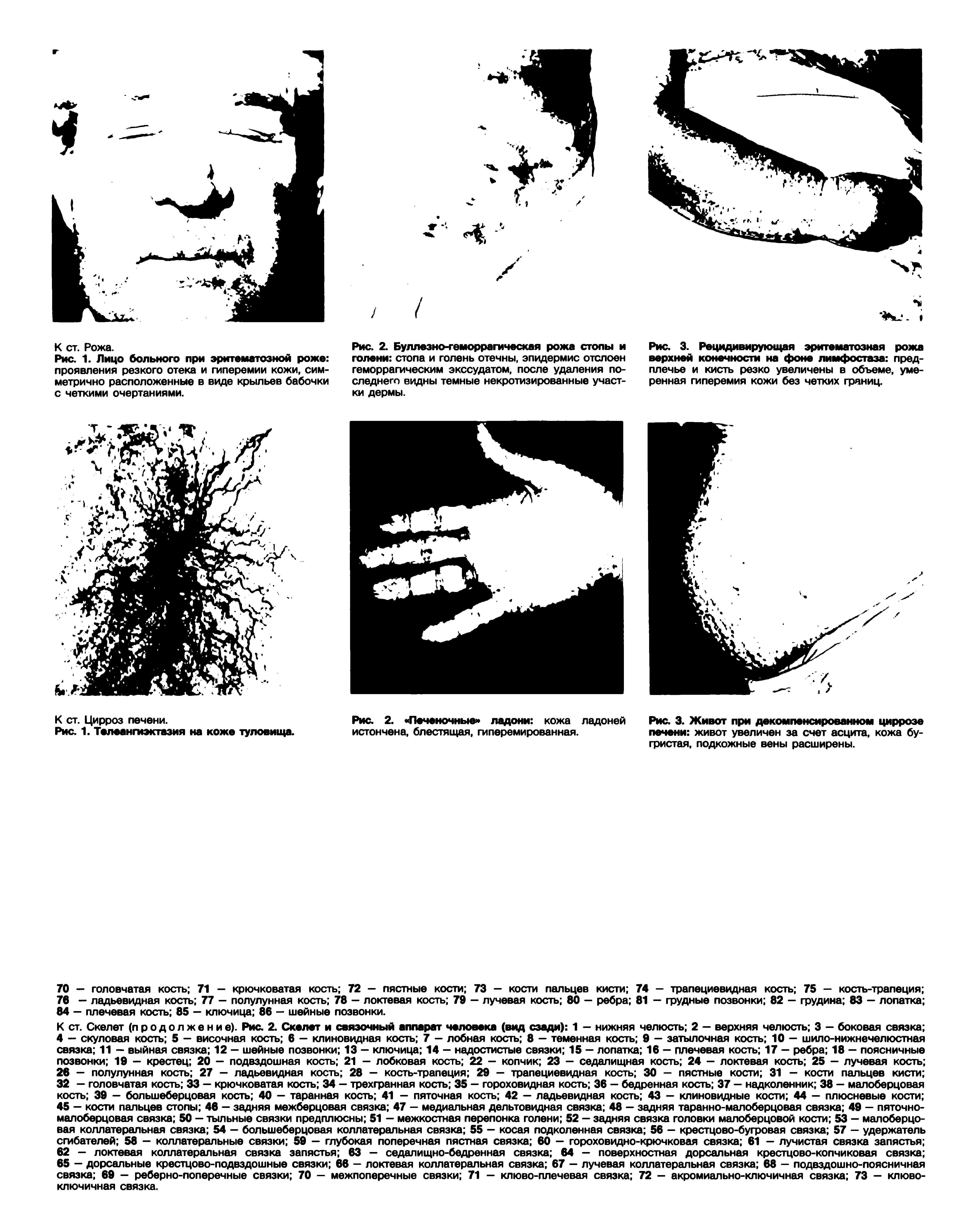 Рис. 2. Буллезно-геморрагическая рожа столы и голени стопа и голень отечны, эпидермис отслоен геморрагическим экссудатом, после удаления последнего видны темные некротизированные участки дермы.