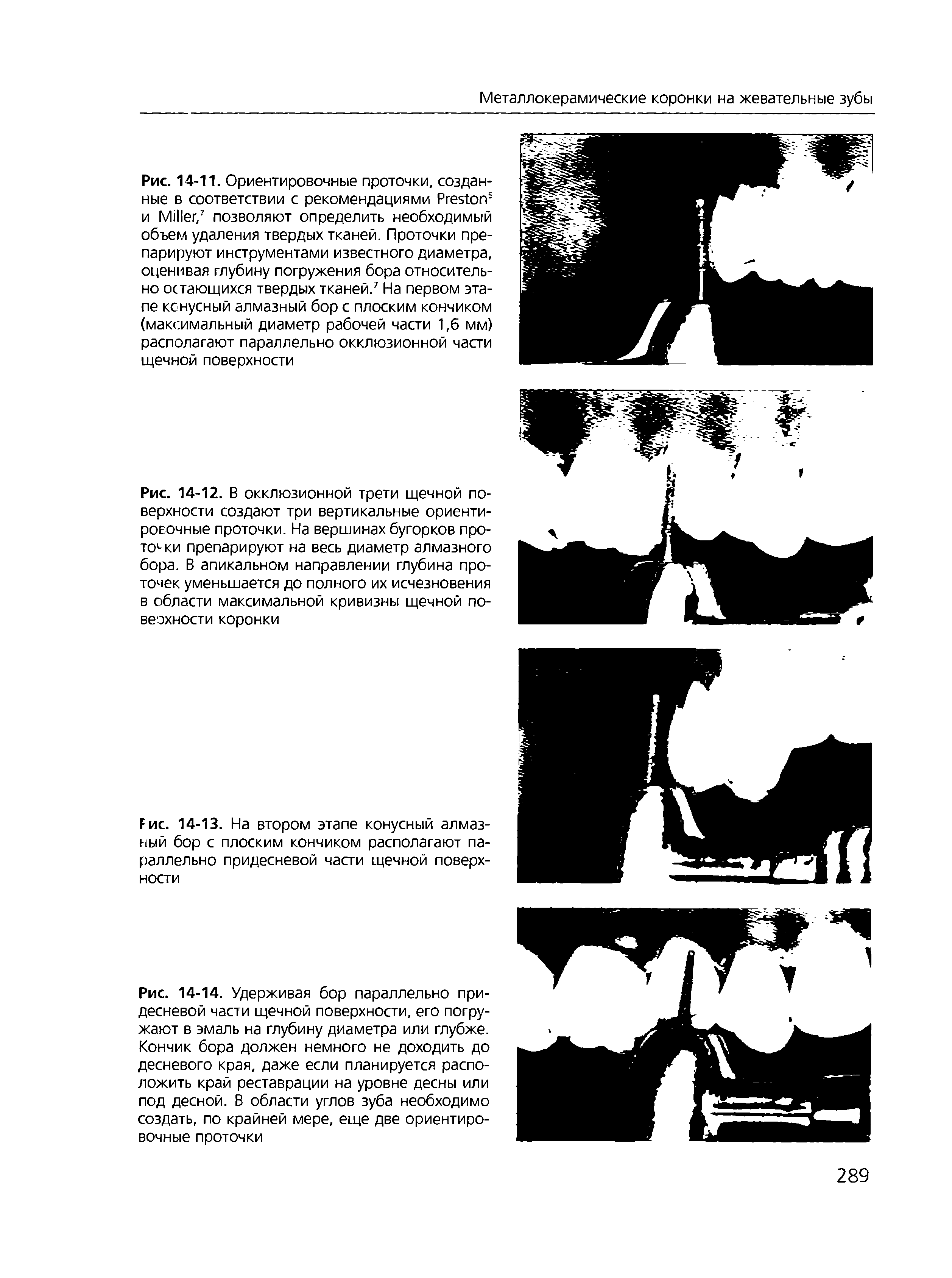 Рис. 14-13. На втором этапе конусный алмазный бор с плоским кончиком располагают параллельно придесневой части щечной поверхности...