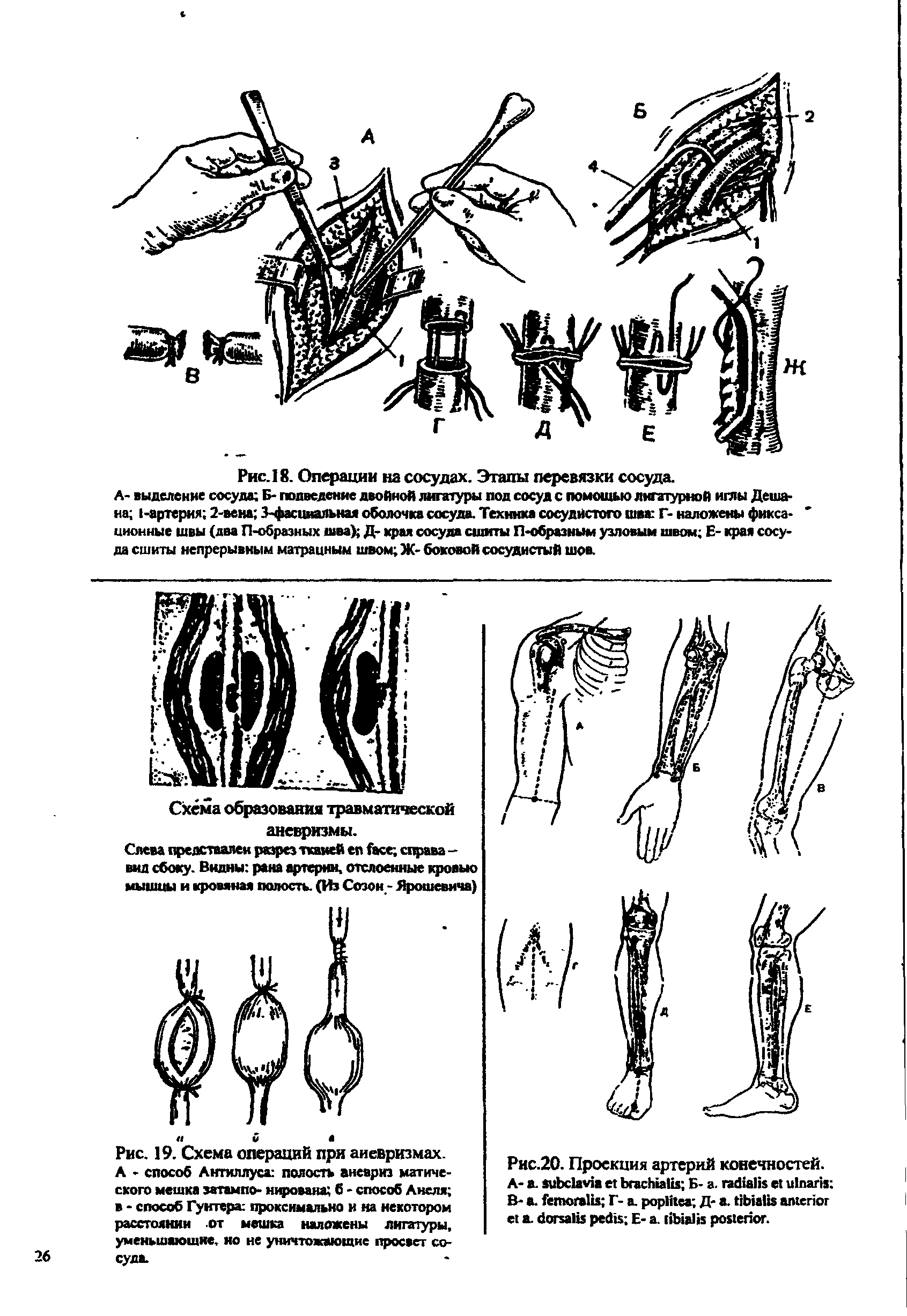 Рис. 19. Схема операций при аневризмах. А - способ Антиллуса полость аневриз матиче-ского мешка затампо- юфована б - способ Анеля в - способ Гунтера проксимально и на некотором расстоянии от мешка наложены лигатуры, уменьшающие, ио не уничтожающие просвет сосуда.
