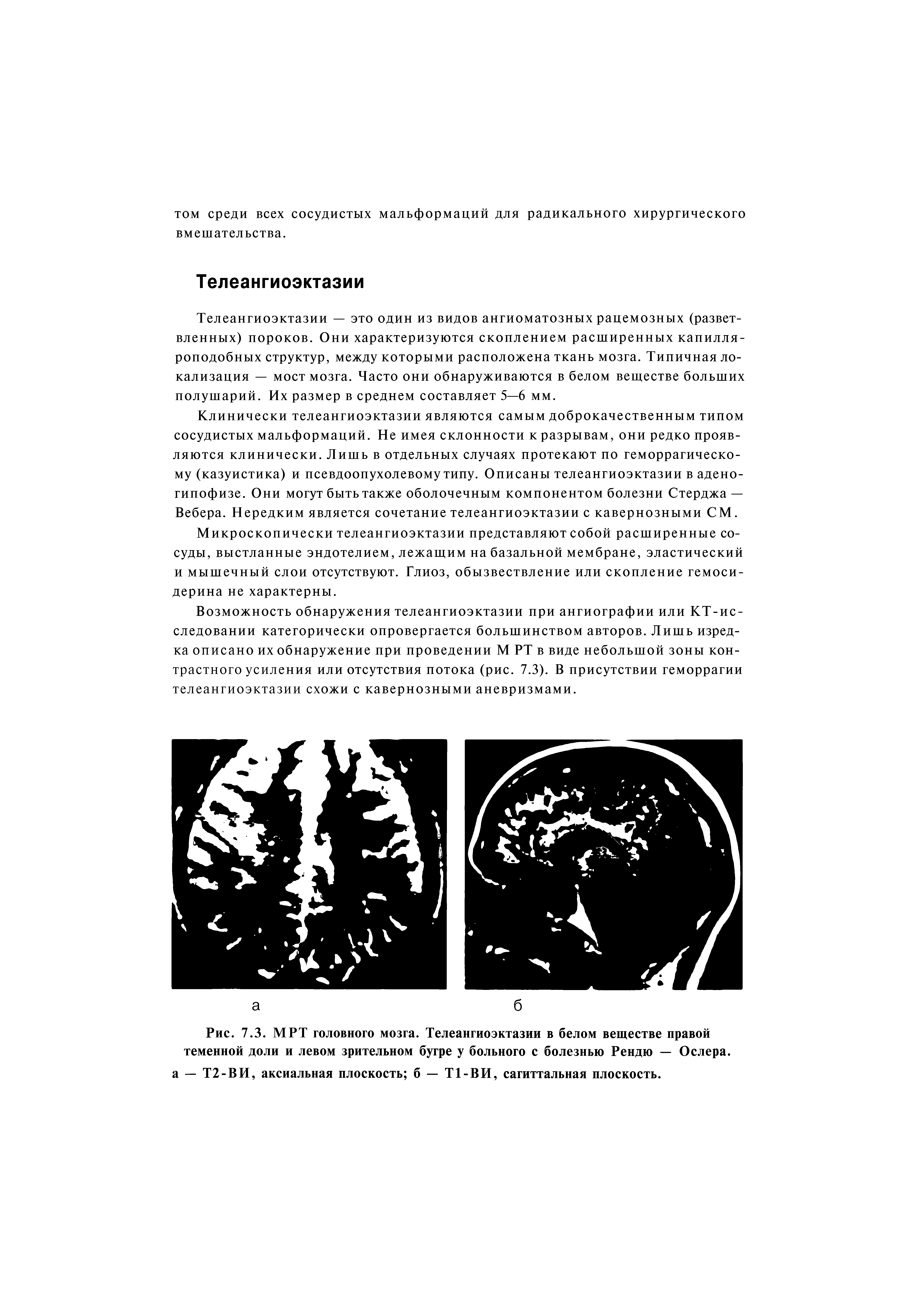 Рис. 7.3. МРТ головного мозга. Телеангиоэктазии в белом веществе правой теменной доли и левом зрительном бугре у больного с болезнью Рендю — Ослера.
