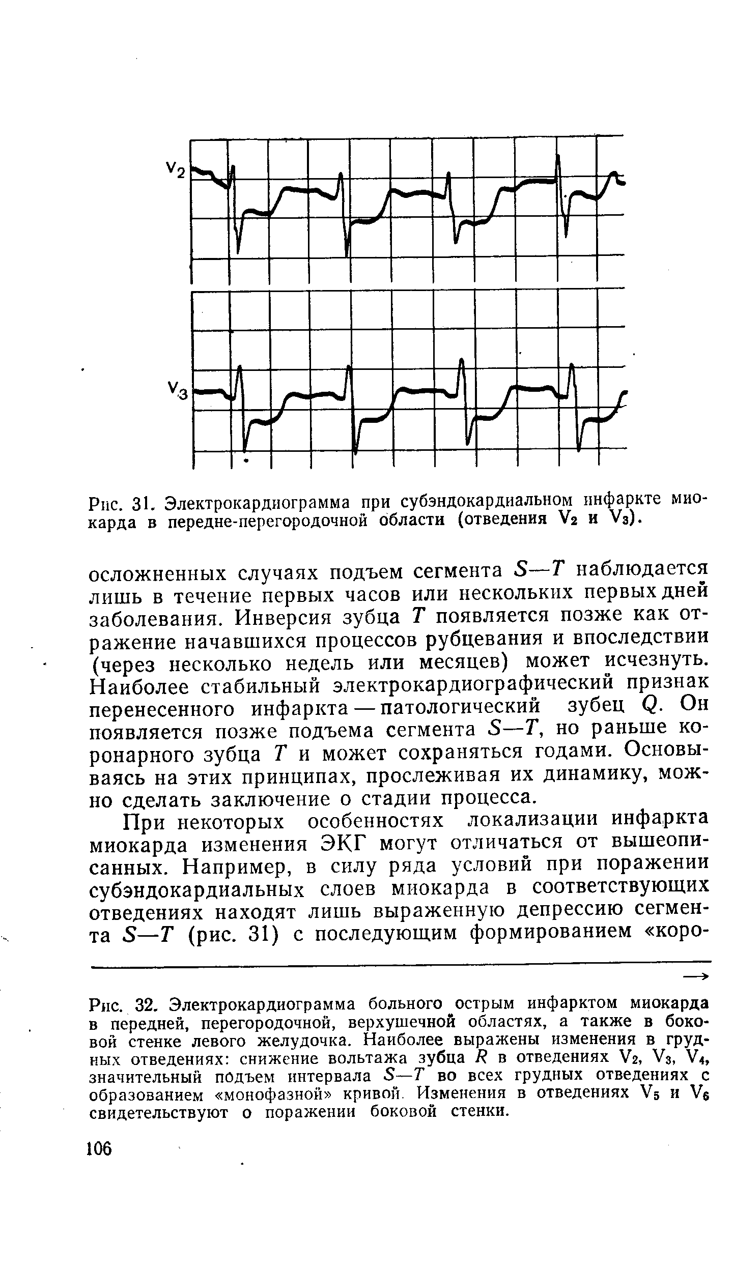 Рис. 31. Электрокардиограмма при субэндокардиальном инфаркте миокарда в передне-перегородочной области (отведения У2 и Уз).