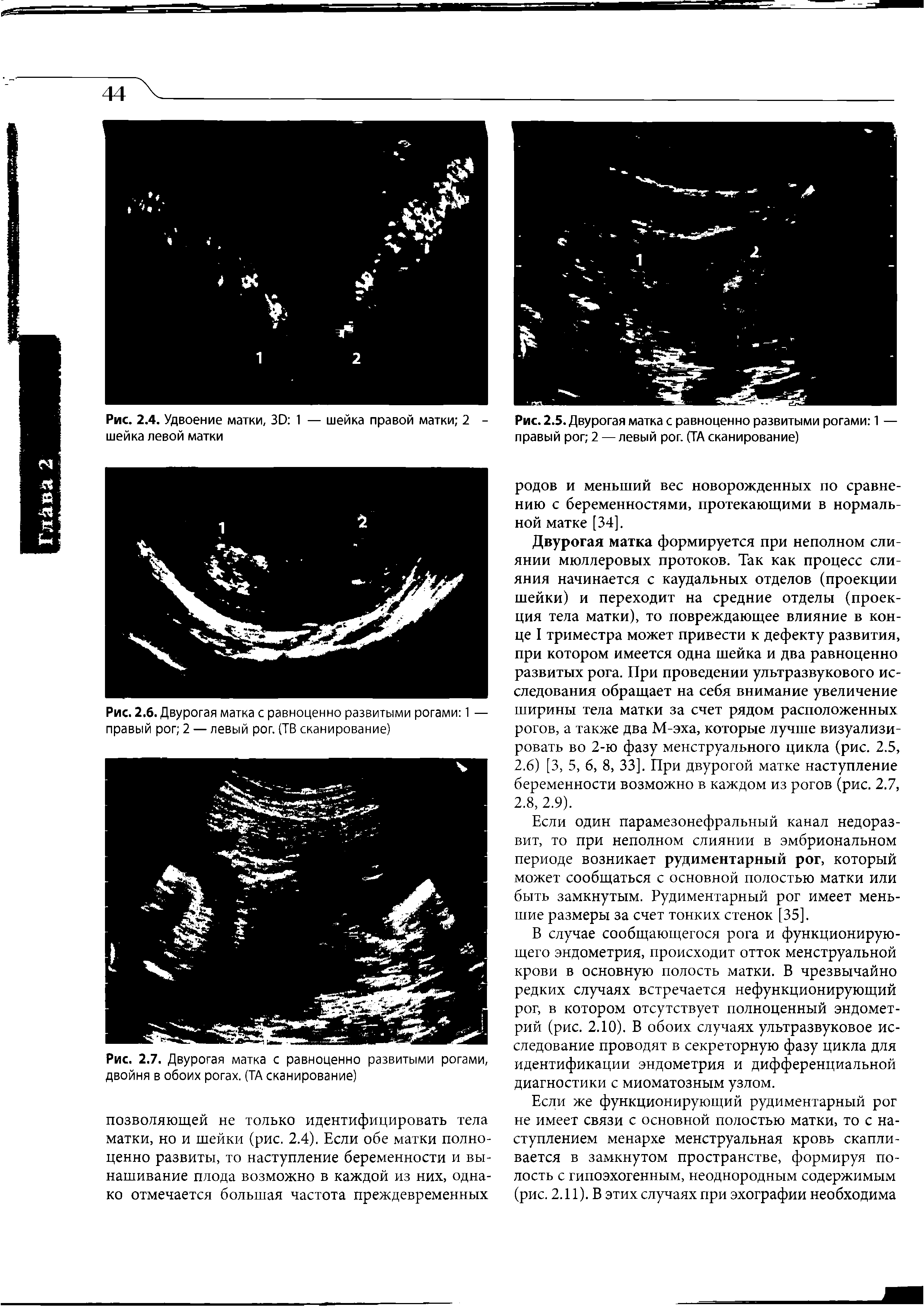 Рис. 2.7. Двурогая матка с равноценно развитыми рогами, двойня в обоих рогах. (ТА сканирование)...