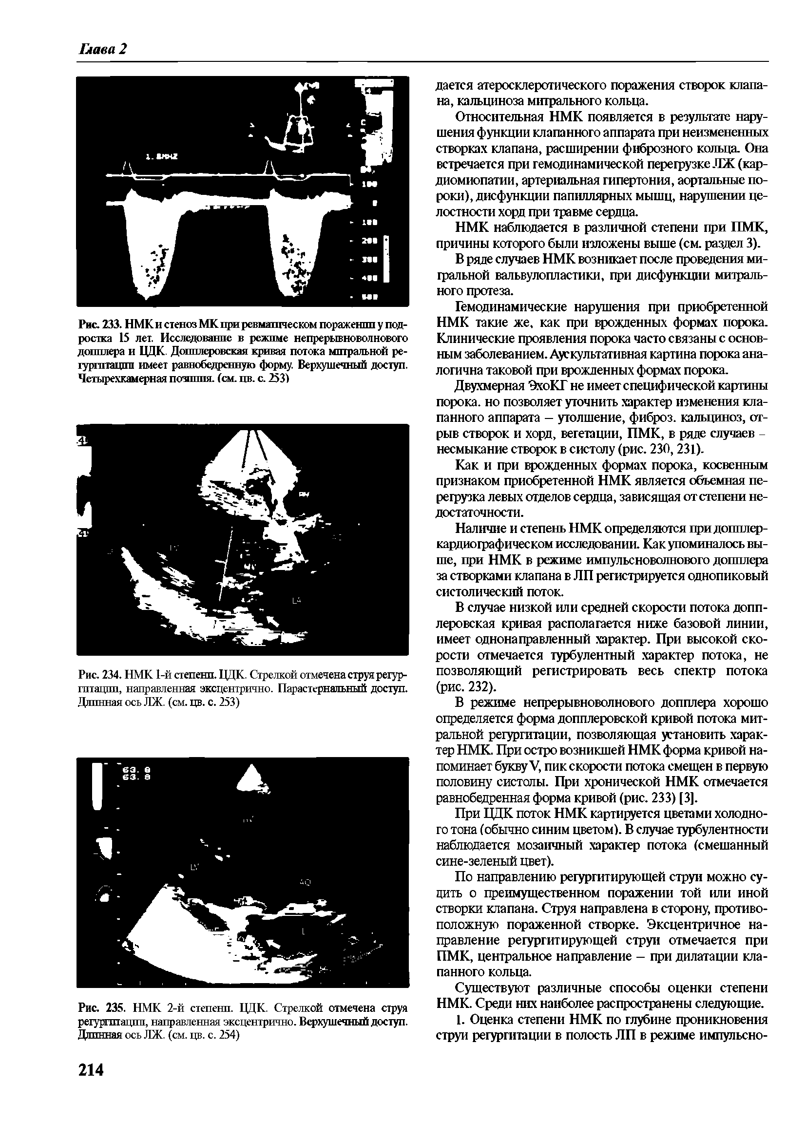 Рис. 233. НМК и стеноз МК при ревматическом поражении у подростка 15 лет. Исследование в режиме непрерывноволнового допплера и ЦДК. Допплеровская кривая потока митральной регургитации имеет равнобедренную форму. Верхушечный доступ. Четырехкамерная позппия. (см. цв. с. 253)...