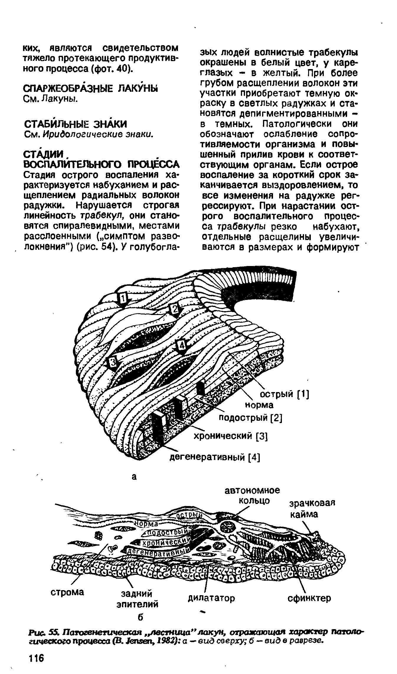 Рис. 55. Патогенетическая лестница" лакун, отражающая характер патологического процесса (В. J , 1982) а —вид сверху б —виде разрезе.