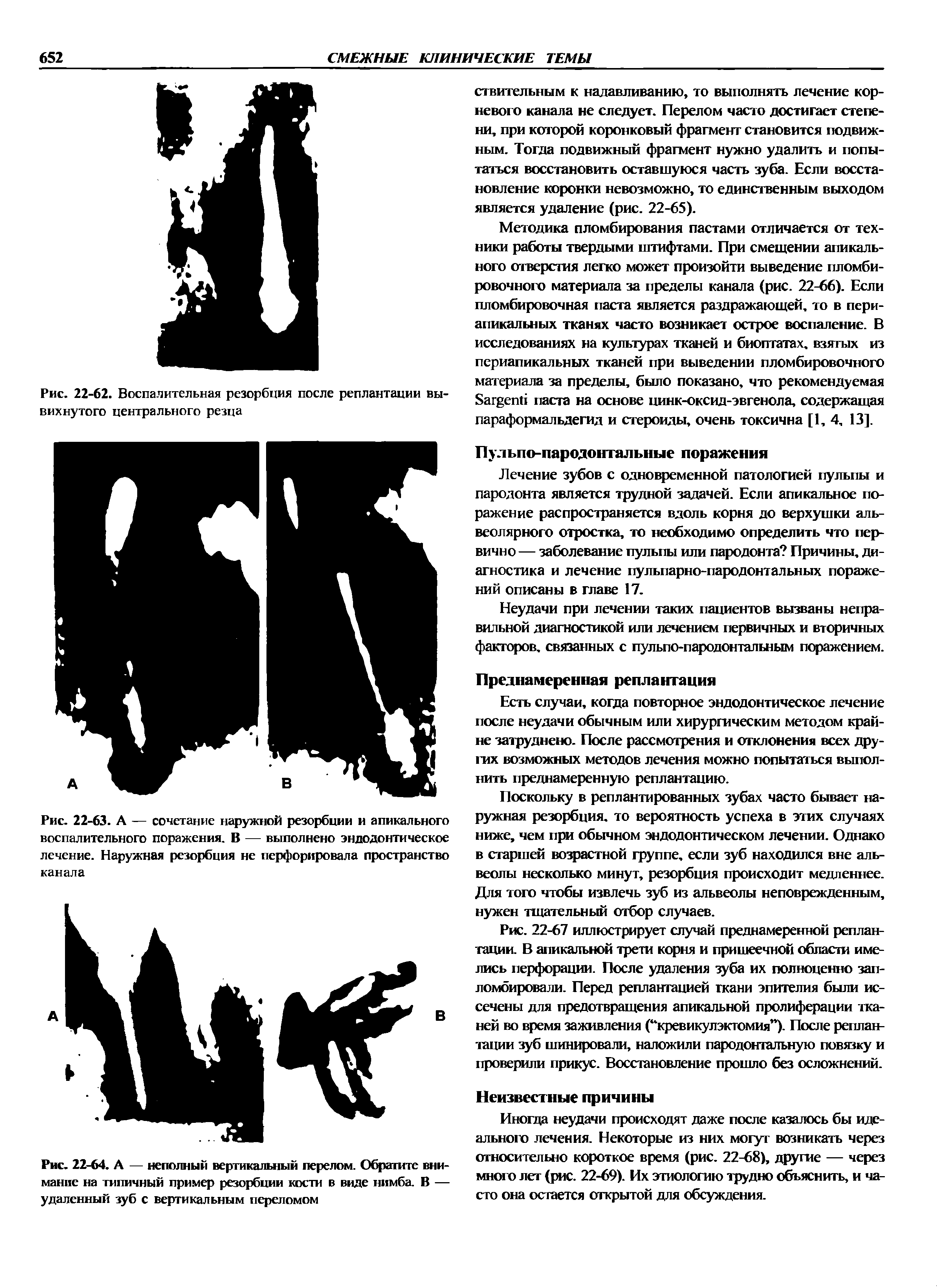 Рис. 22-64. А — неполный вертикальный перелом. Обратите внимание на типичный пример резорбции кости в виде нимба. В — удаленный зуб с вертикальным переломом...