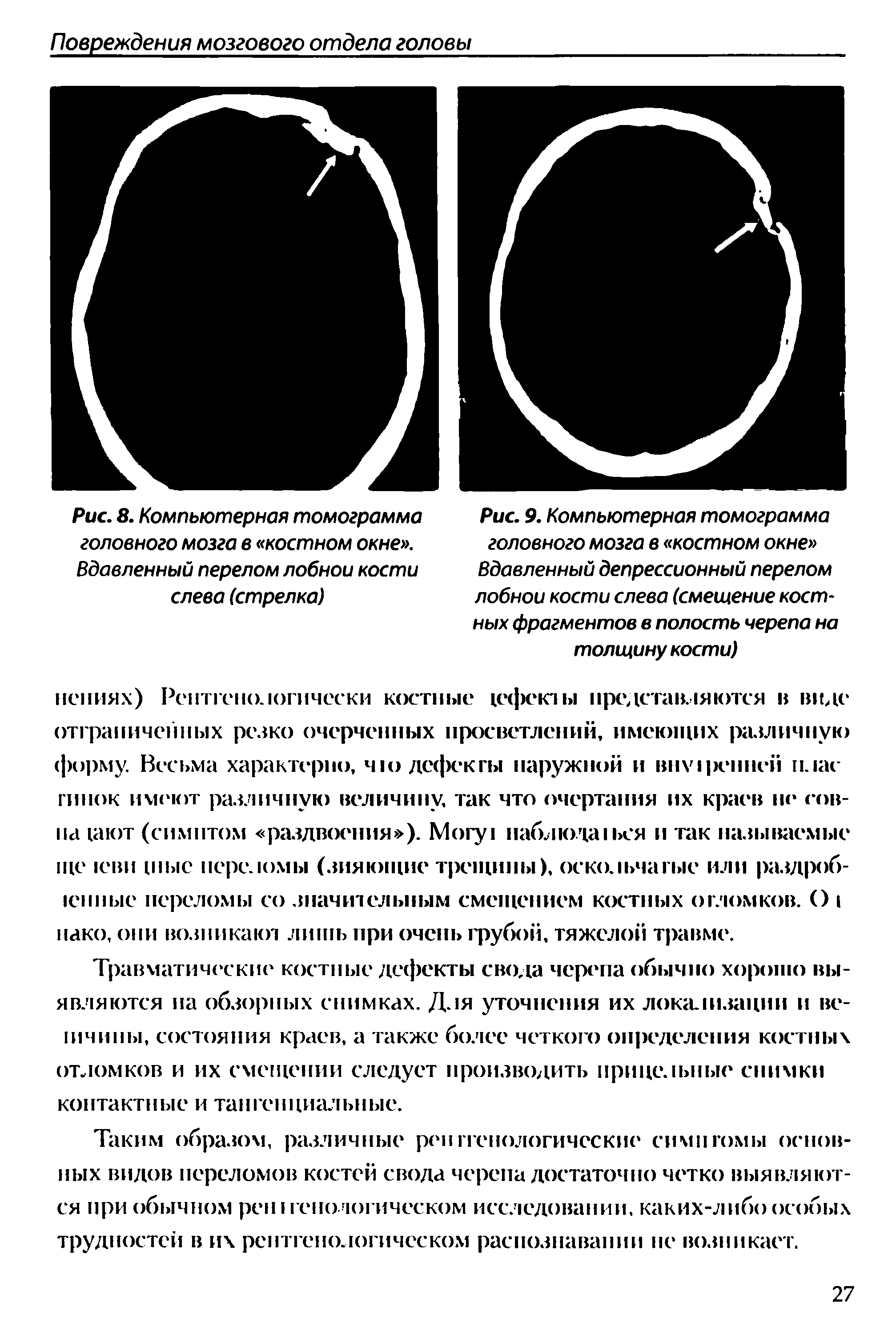 Рис. 9. Компьютерная томограмма головного мозга в костном окне Вдавленный депрессионный перелом лобной кости слева (смещение костных фрагментов в полость черепа на толщину кости)...