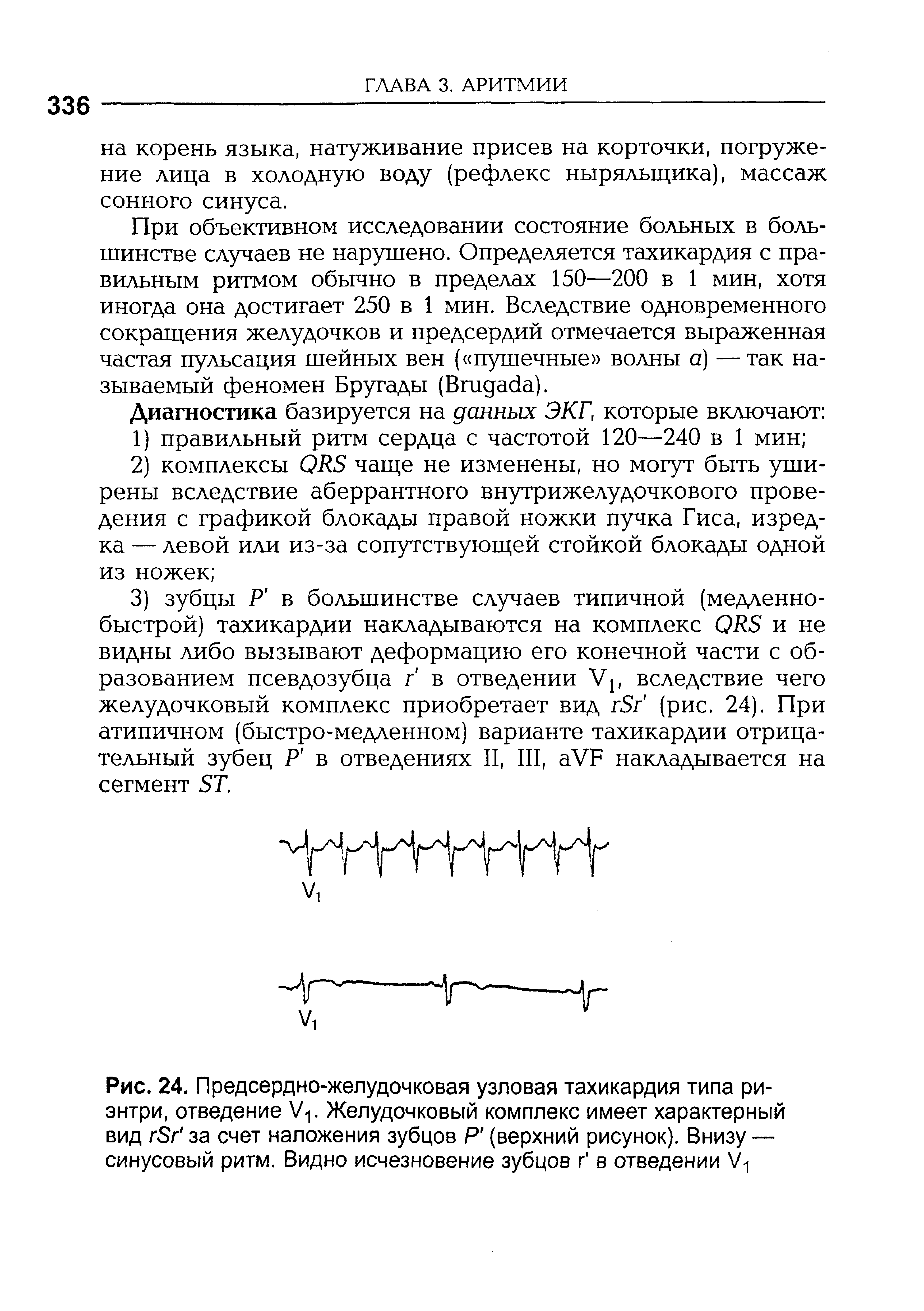 Рис. 24. Предсердно-желудочковая узловая тахикардия типа ри-энтри, отведение Ур Желудочковый комплекс имеет характерный вид гЭГ за счет наложения зубцов Р (верхний рисунок). Внизу — синусовый ритм. Видно исчезновение зубцов г в отведении У1...