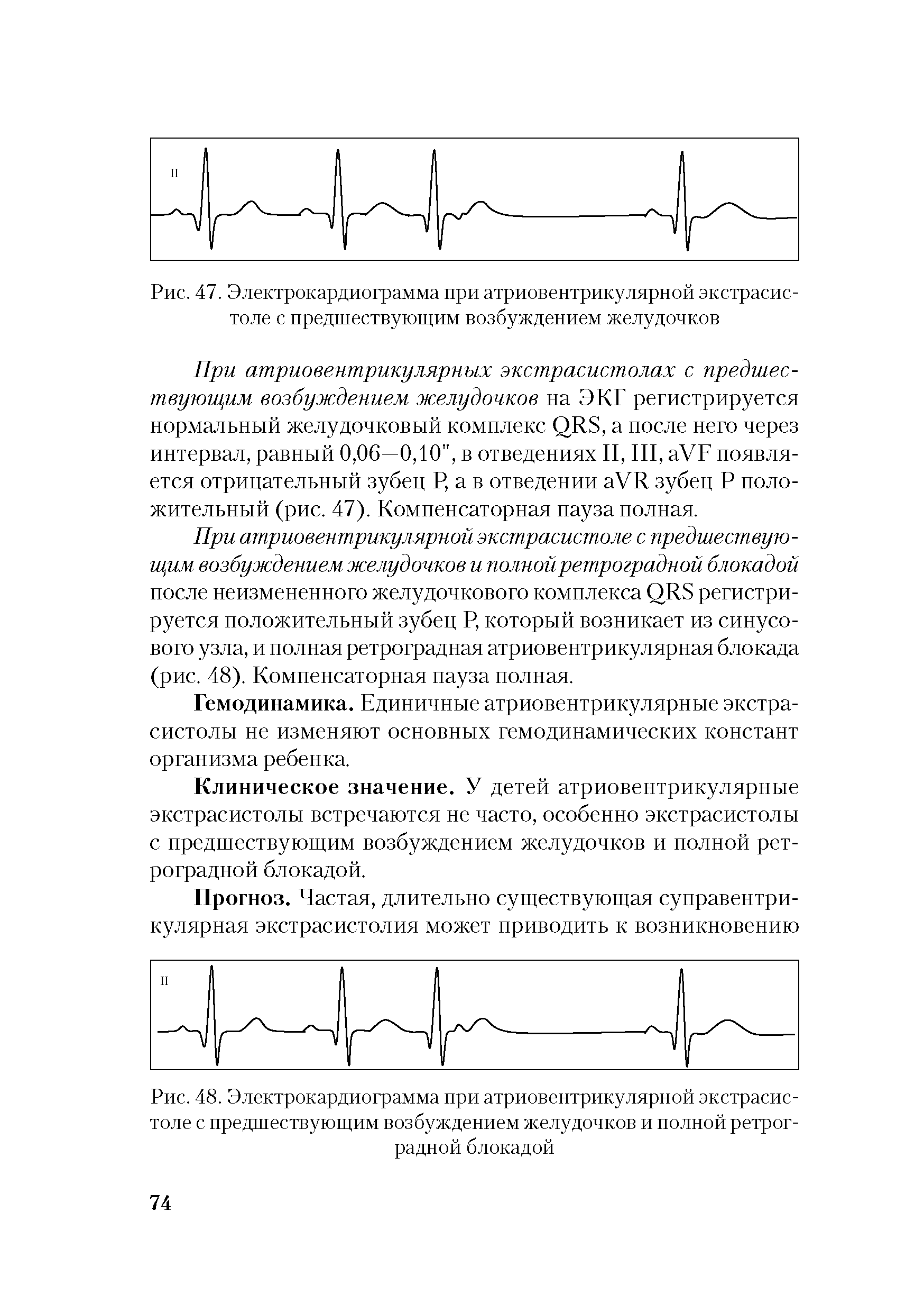 Рис. 48. Электрокардиограмма при атриовентрикулярной экстрасистоле с предшествующим возбуждением желудочков и полной ретроградной блокадой...