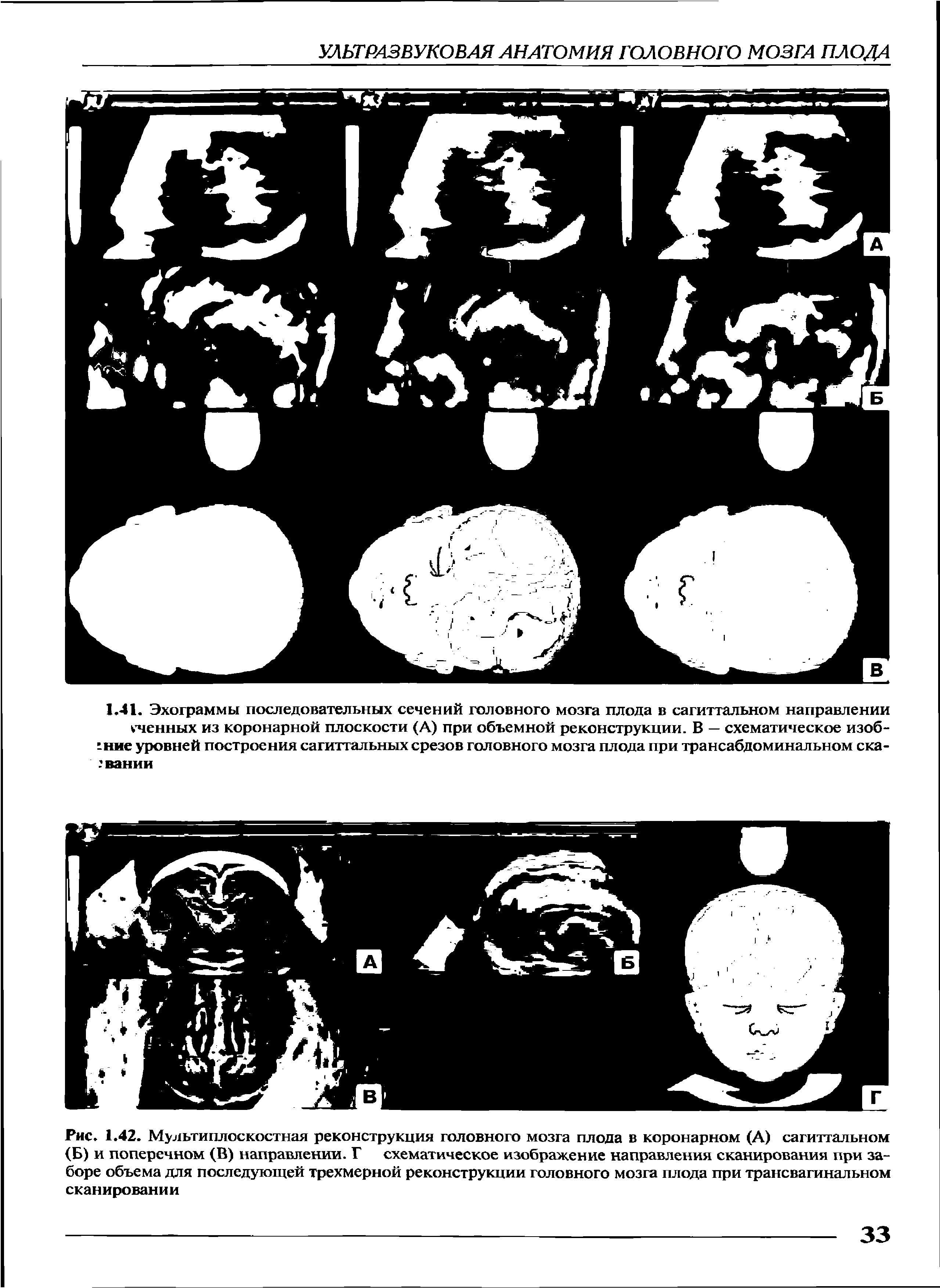 Рис. 1.42. Мультиплоскостная реконструкция головного мозга плода в коронарном (А) сагиттальном (Б) и поперечном (В) направлении. Г схематическое изображение направления сканирования при заборе объема для последующей трехмерной реконструкции головного мозга плода при трансвагинальном сканировании...