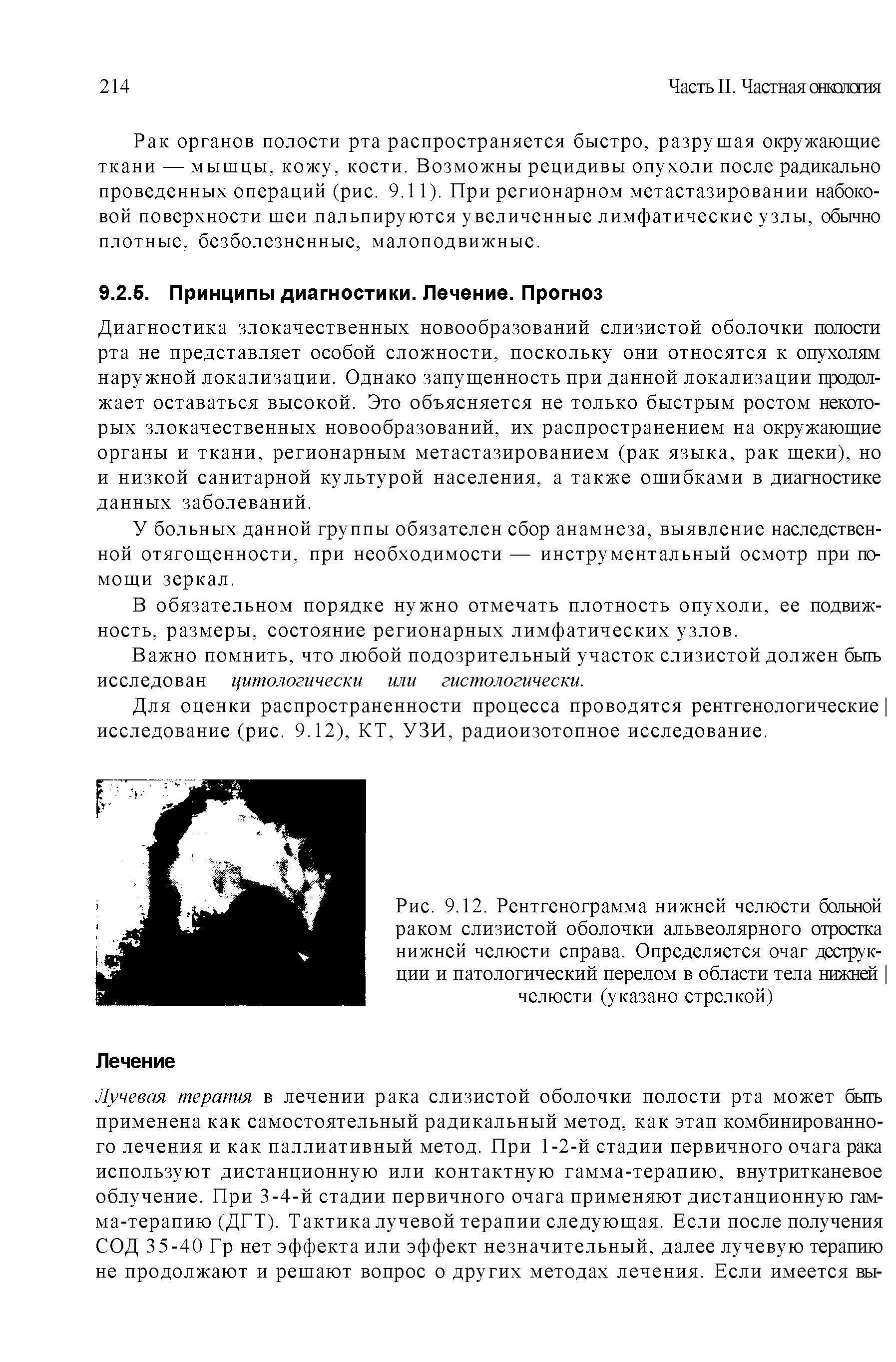 Рис. 9.12. Рентгенограмма нижней челюсти бальной раком слизистой оболочки альвеолярного отростка нижней челюсти справа. Определяется очаг деструкции и патологический перелом в области тела нижней челюсти (указано стрелкой)...