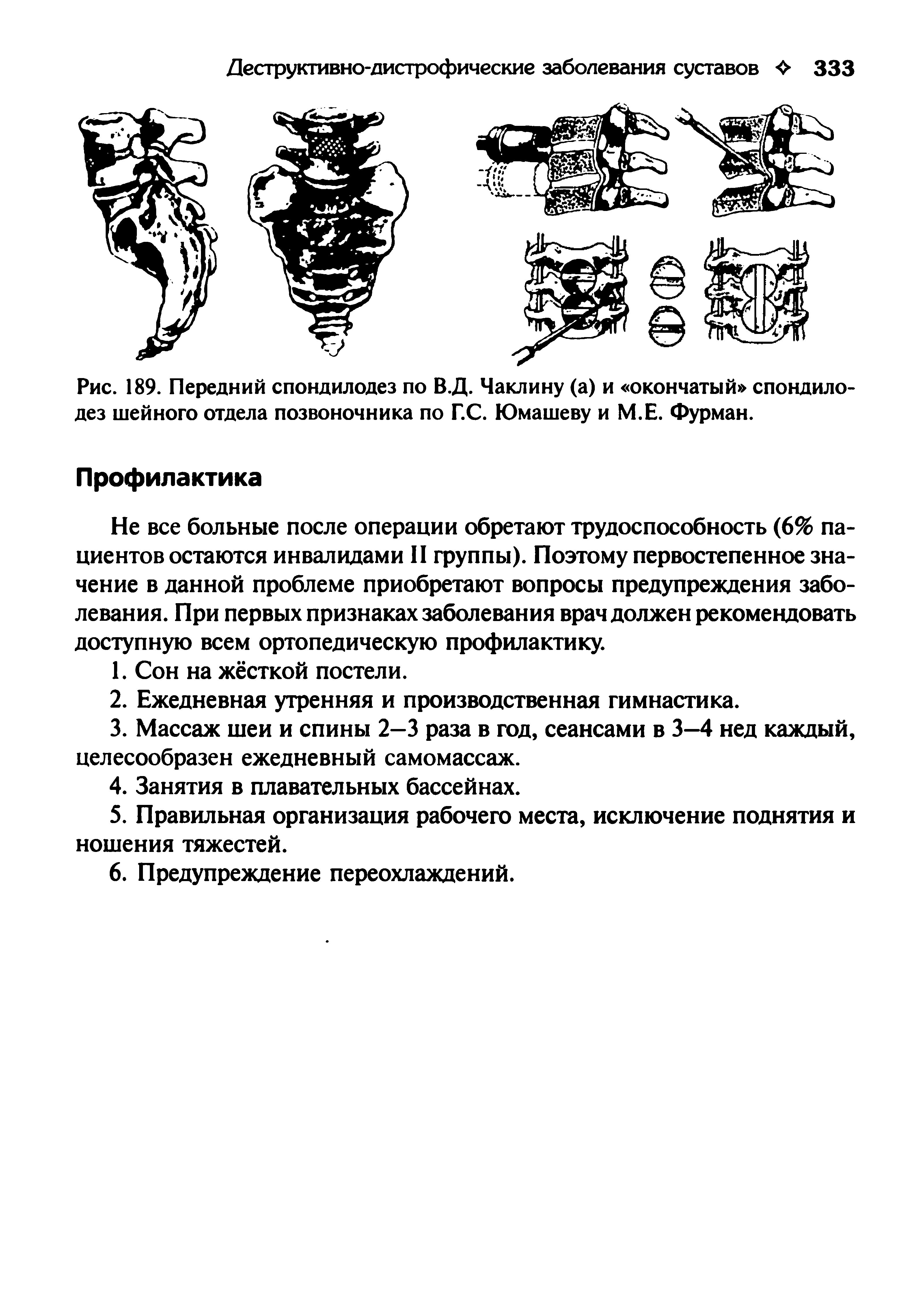 Рис. 189. Передний спондилодез по В.Д. Чаклину (а) и окончатый спондилодез шейного отдела позвоночника по Г.С. Юмашеву и М.Е. Фурман.