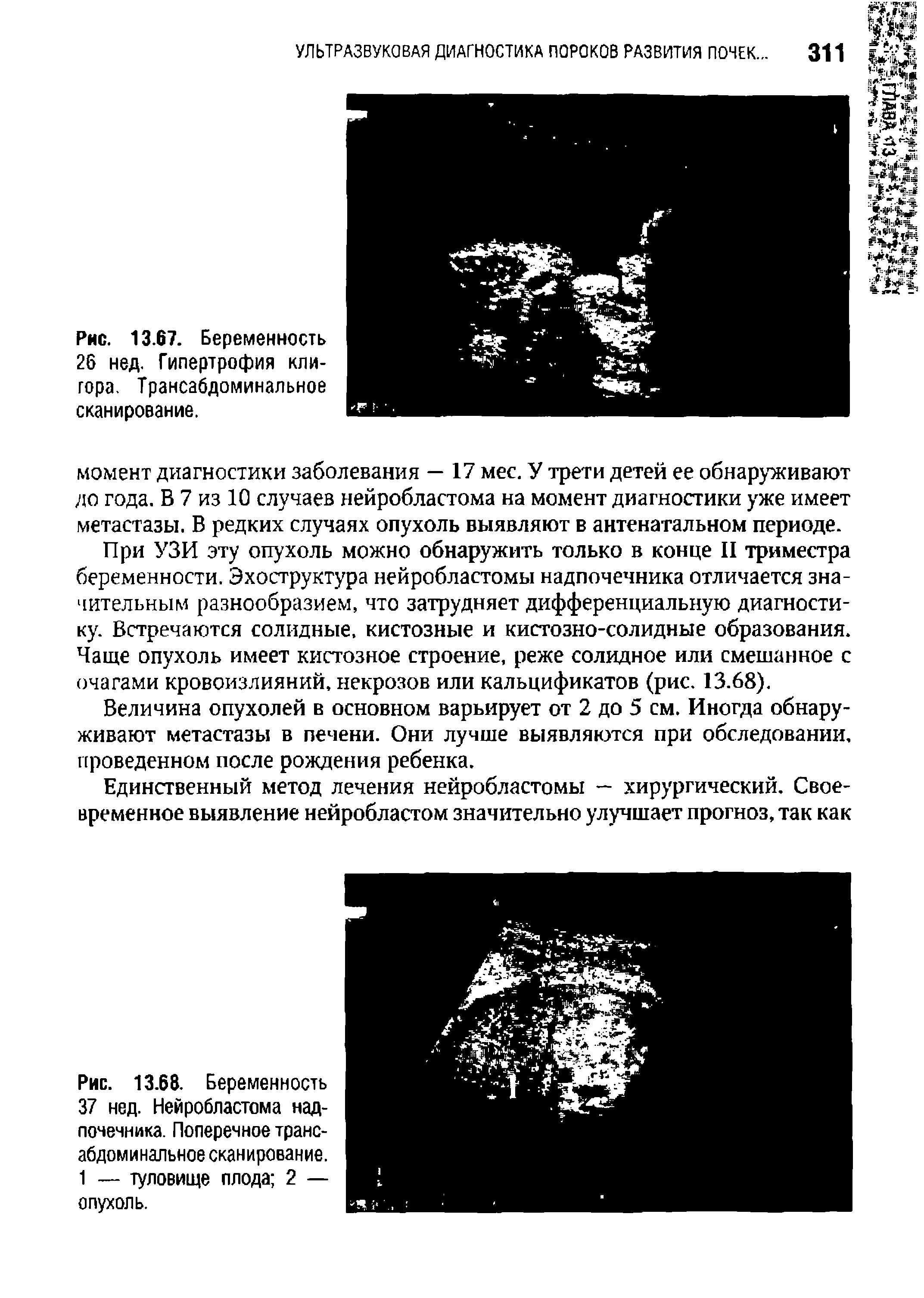 Рис. 13.68. Беременность 37 нед. Нейробластома надпочечника. Поперечное трансабдоминальное сканирование. 1 — туловище плода 2 — опухоль.