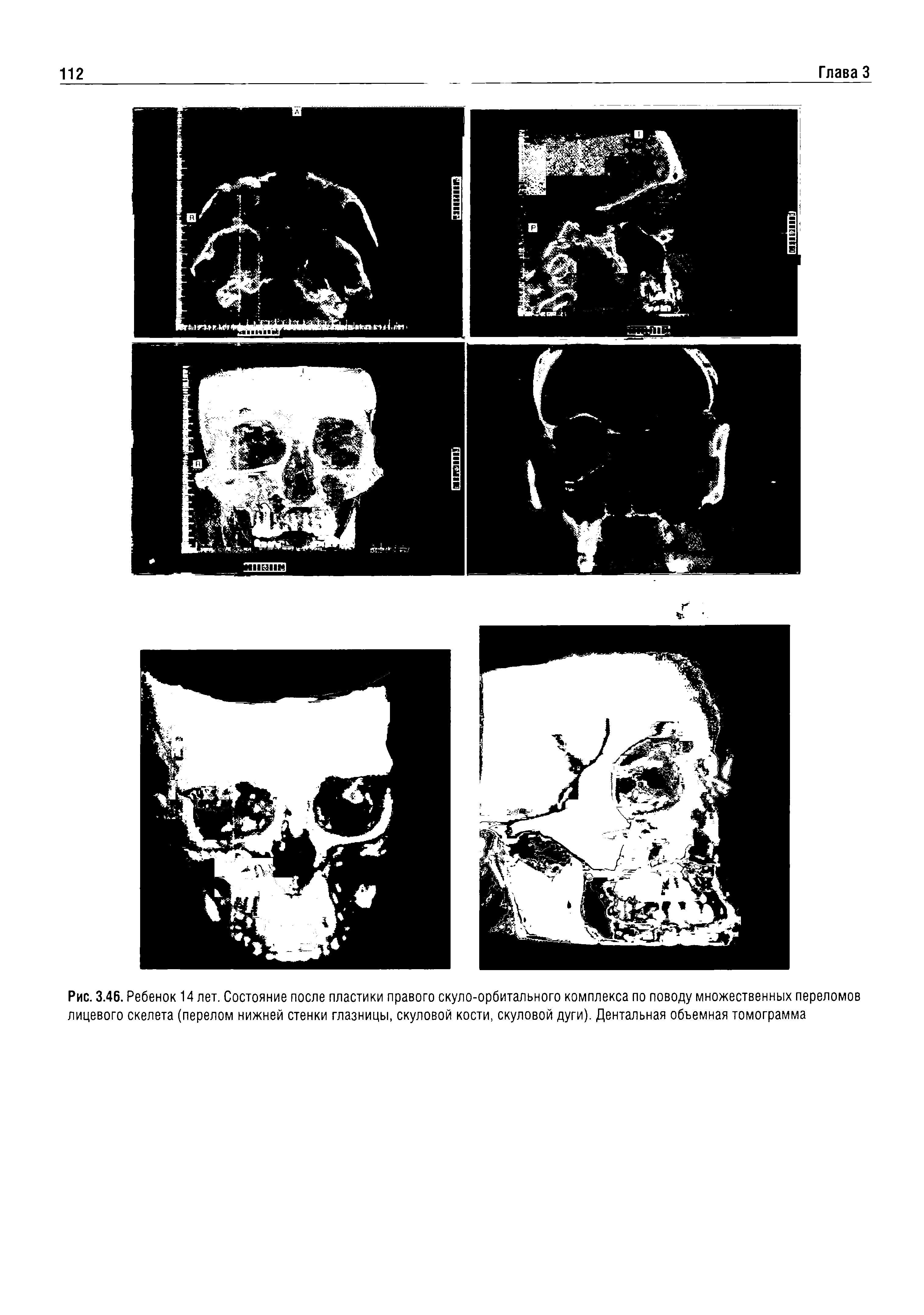 Рис. 3.46. Ребенок 14 лет. Состояние после пластики правого скуло-орбитального комплекса по поводу множественных переломов лицевого скелета (перелом нижней стенки глазницы, скуловой кости, скуловой дуги). Дентальная объемная томограмма...