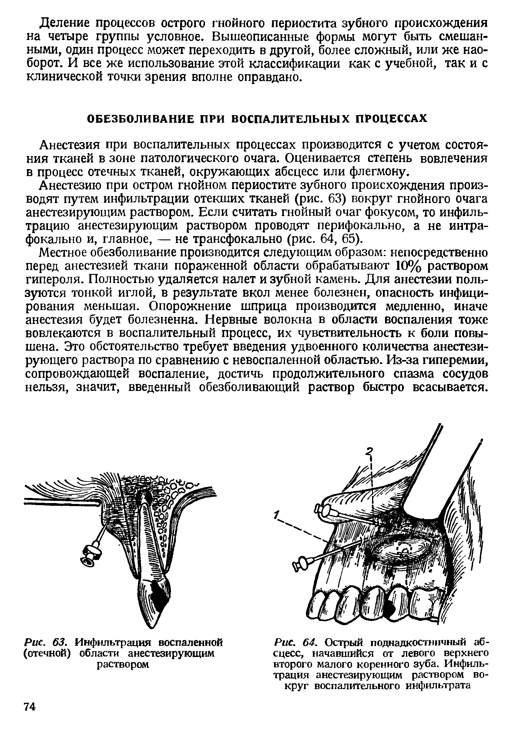 Рис. 64. Острый поднадкостничный абсцесс, начавшийся от левого верхнего второго малого коренного зуба. Инфильтрация анестезирующим раствором вокруг воспалительного инфильтрата...