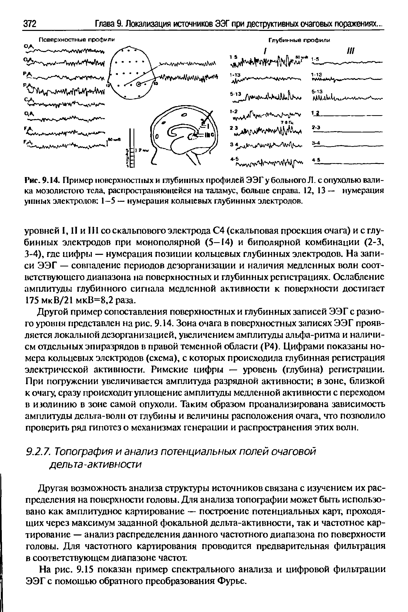 Рис. 9.14. Пример поверхностных и глубинных профилей ЭЭГ у больного Л. с опухолью валика мозолистого тела, распространяющейся на таламус, больше справа. 12, 13 — нумерация ушных электродов 1-5 — нумерация кольцевых глубинных электродов.