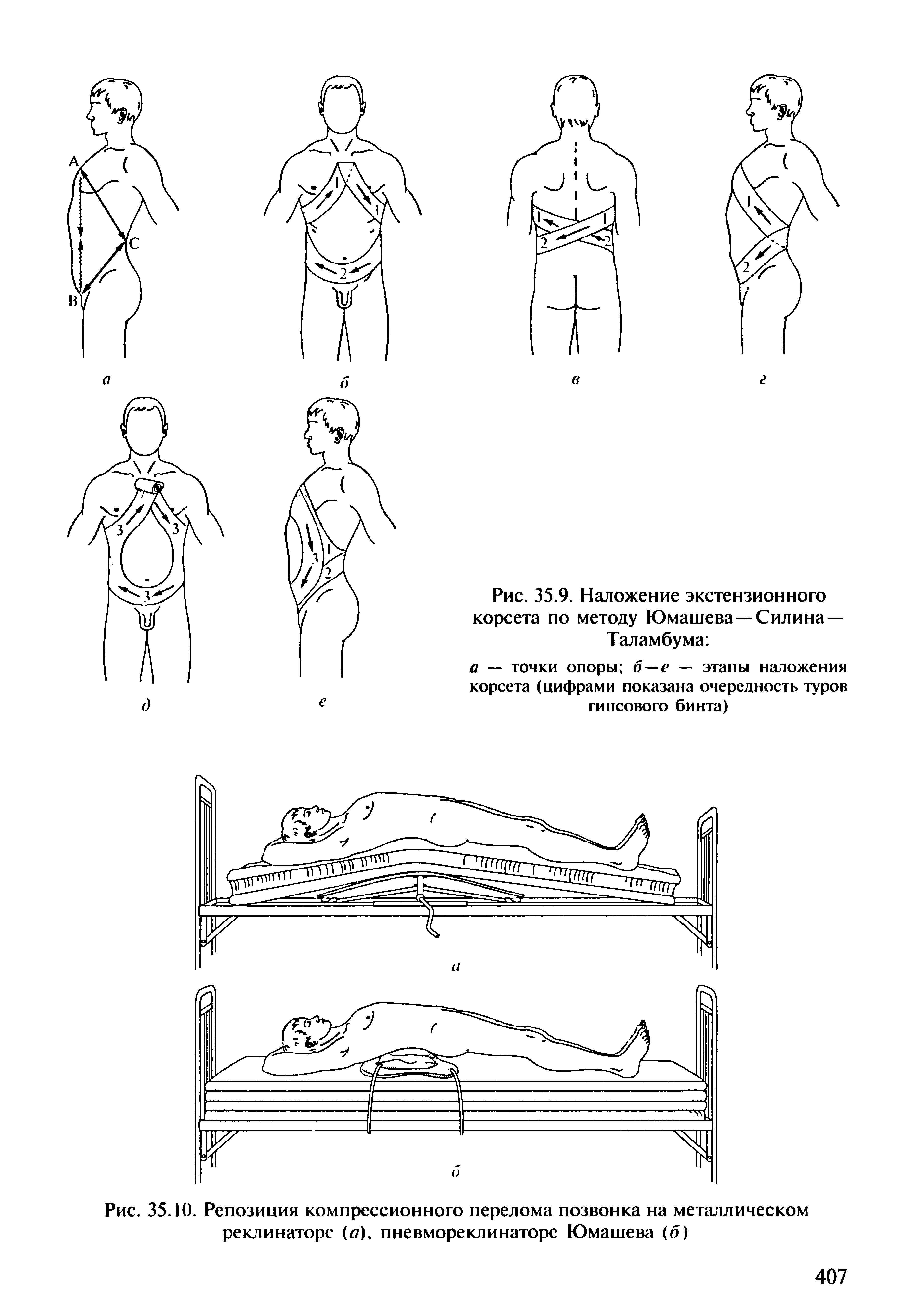 Рис. 35.9. Наложение экстензионного корсета по методу Юмашева —Силина — Таламбума ...
